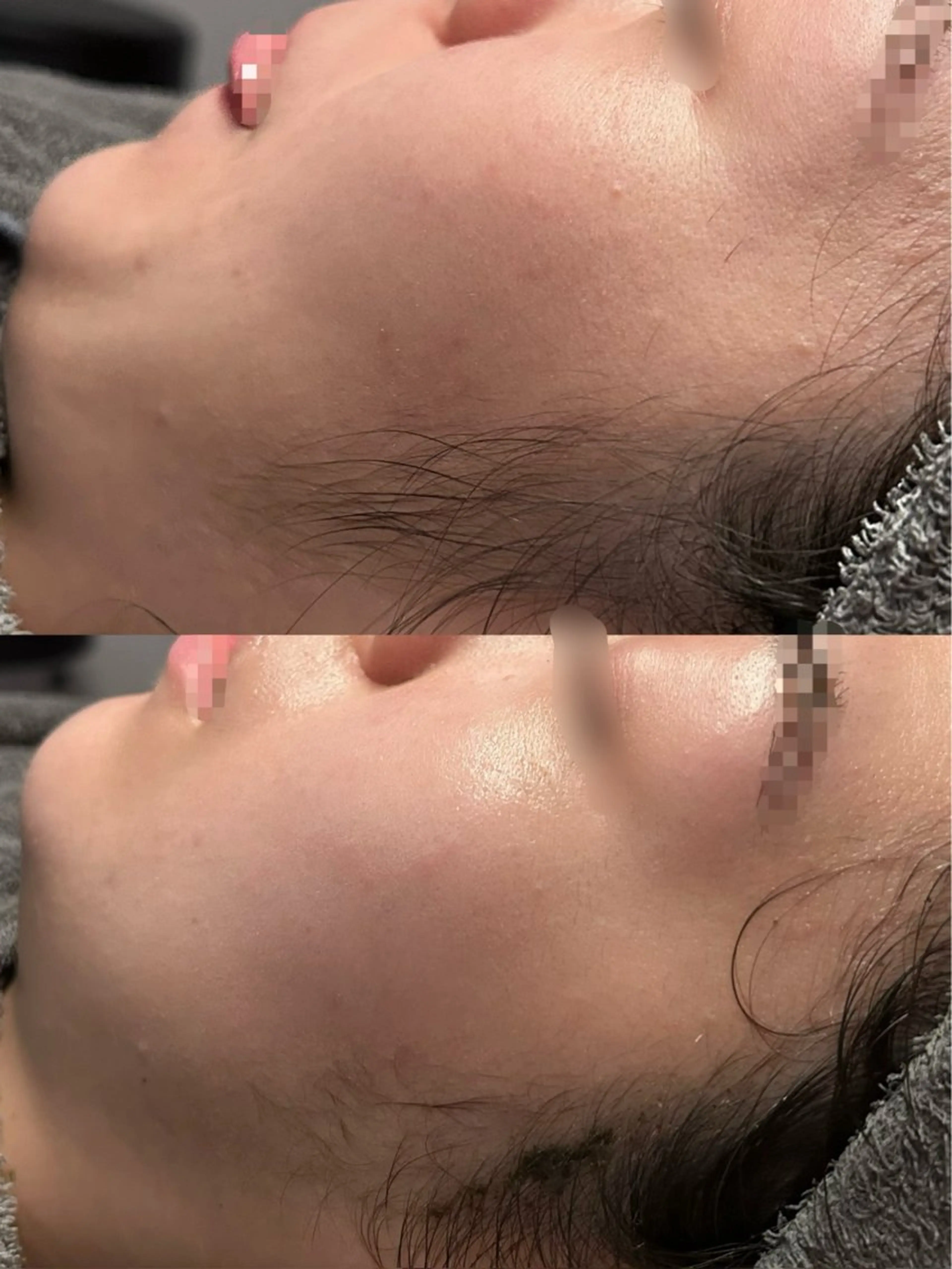 【1月〜💆♀️】ハーブピーリング🌿オプション3つ🎁10.000円OFFの写真