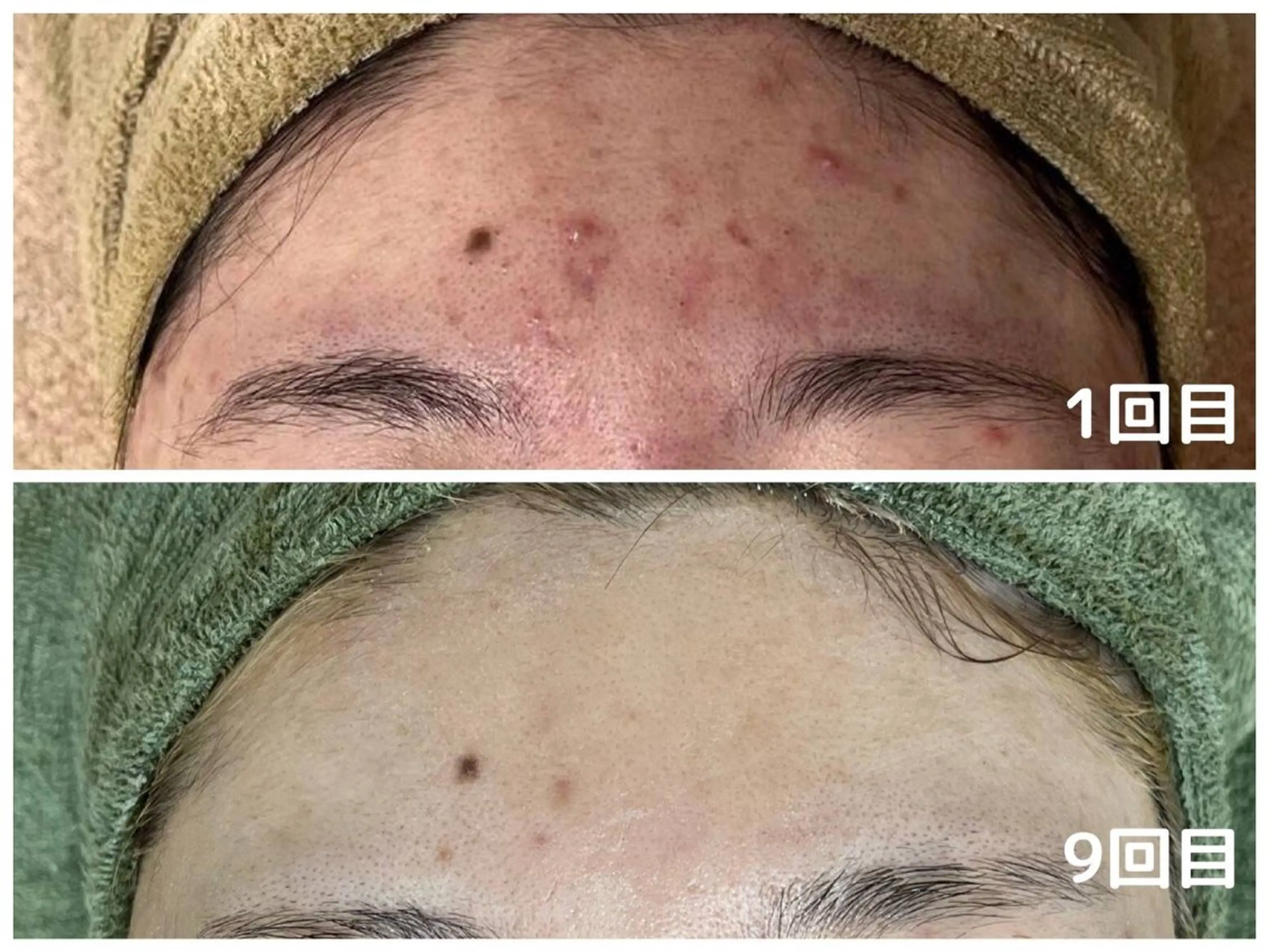 韓国美肌/肌質改善 【天神】yuiのエステ・リラクイメージ