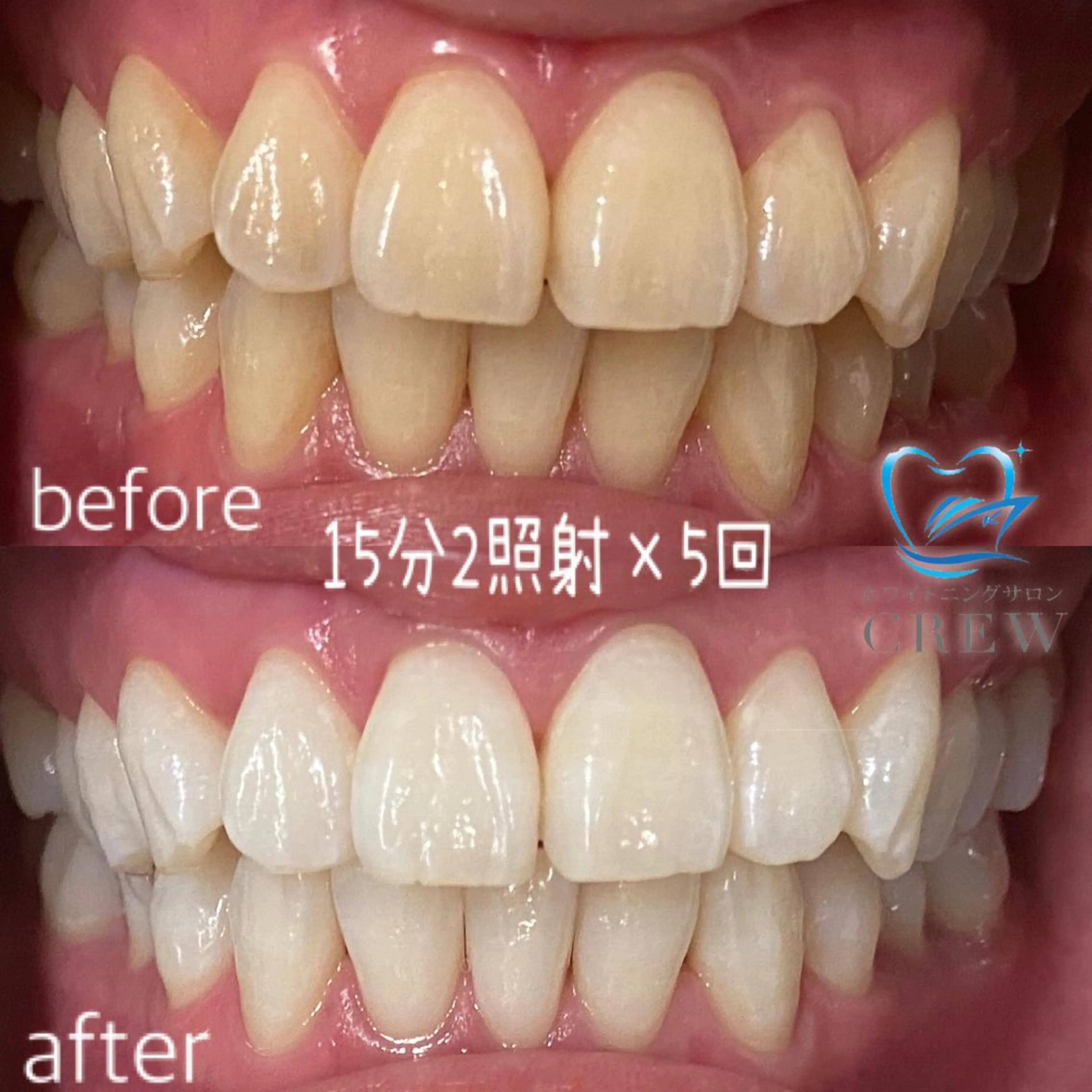 メンズ ネイル マツエク・マツパ その他 ホワイトニング ⚓︎CREW柏⚓︎のその他イメージ