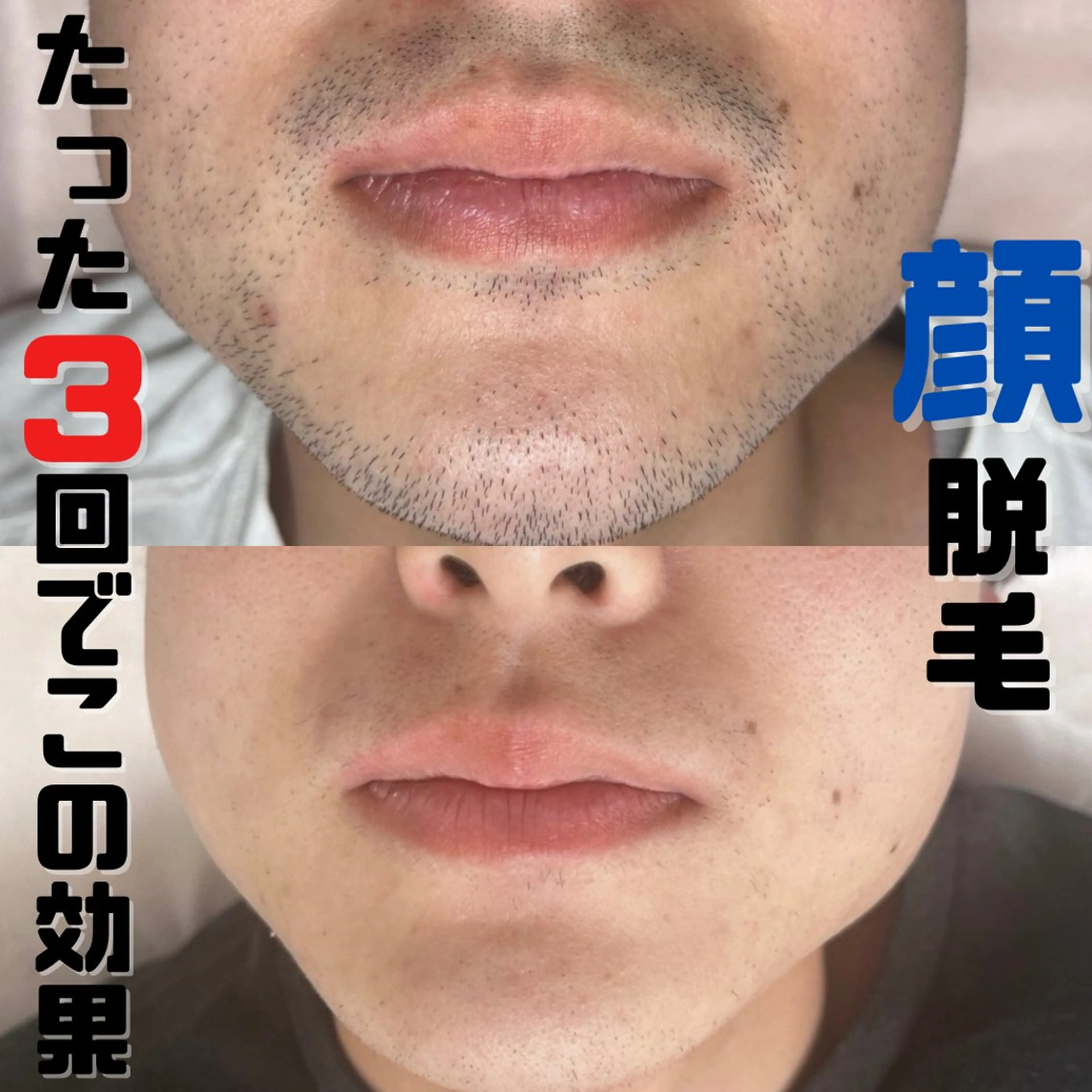 NPL脱毛🌈✨️お好きな部位(1部位)6000円の写真