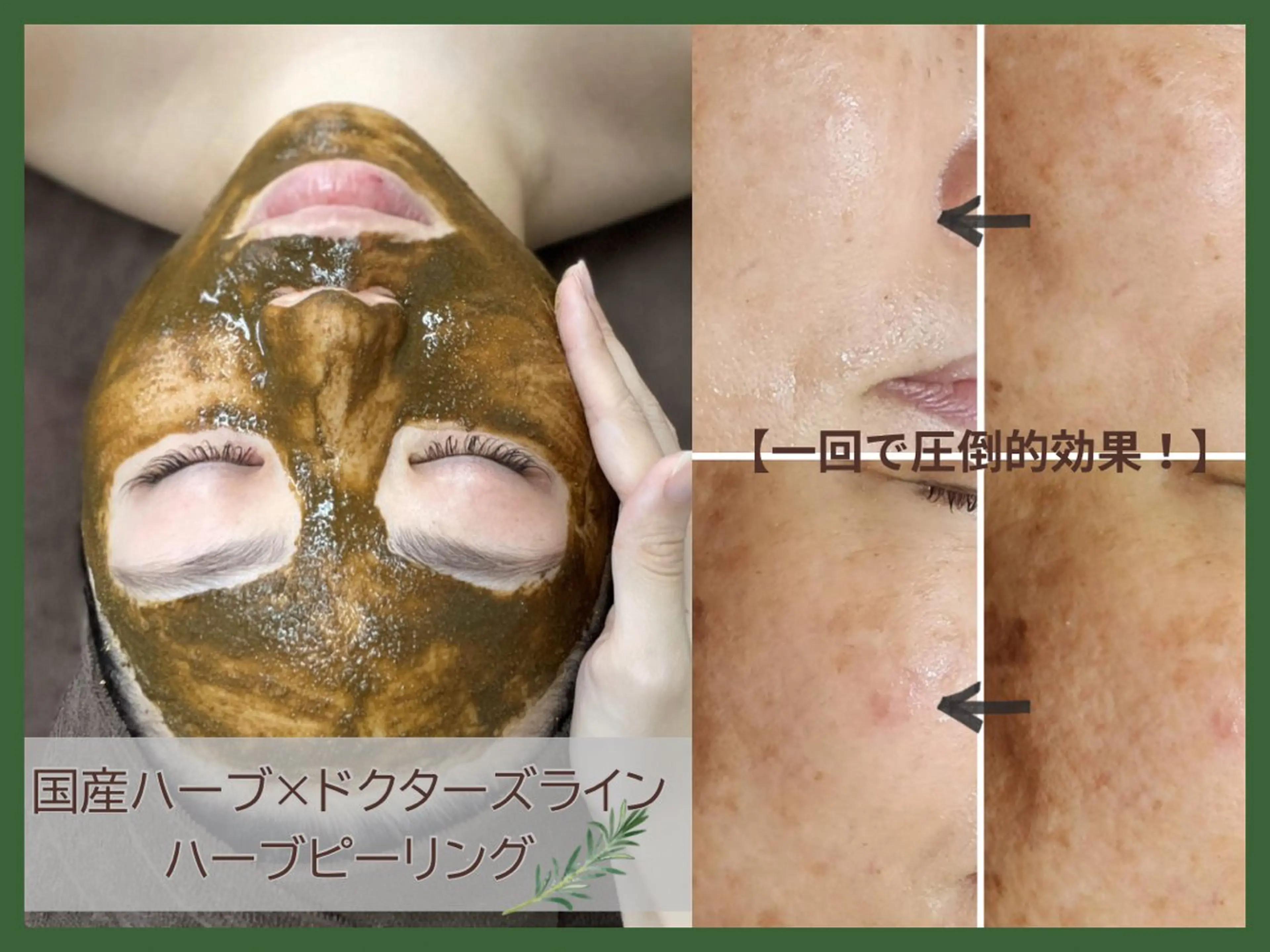 大人気♡ハーブピーリング🌿（全顔）¥5,000❣️国産×ドクターズラインで一回でも即効果あり✨の写真