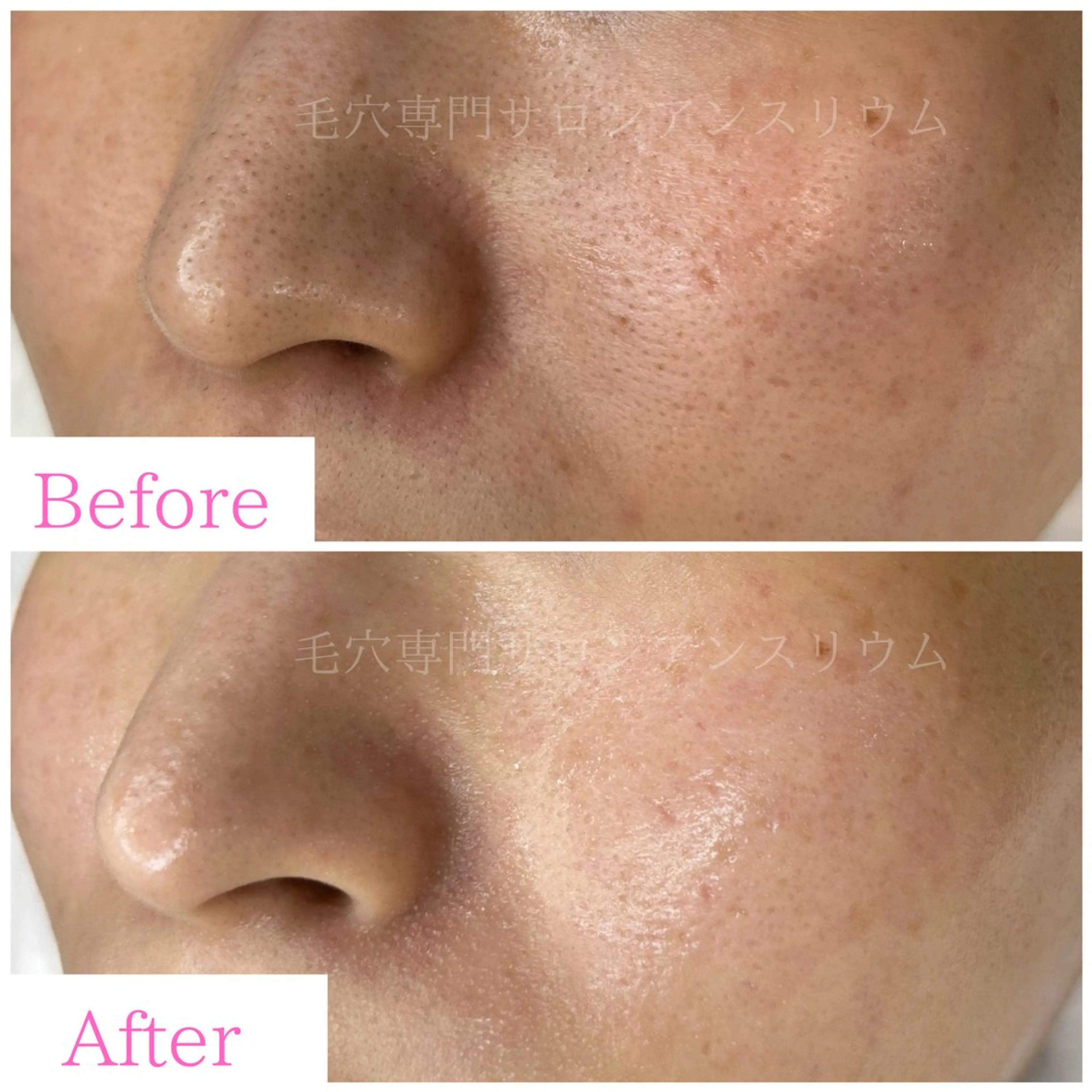 毛穴ケア専門サロンアンスリウム所属・茨城土浦 つくば毛穴 ケア専門サロンのエステ・リラクイメージ