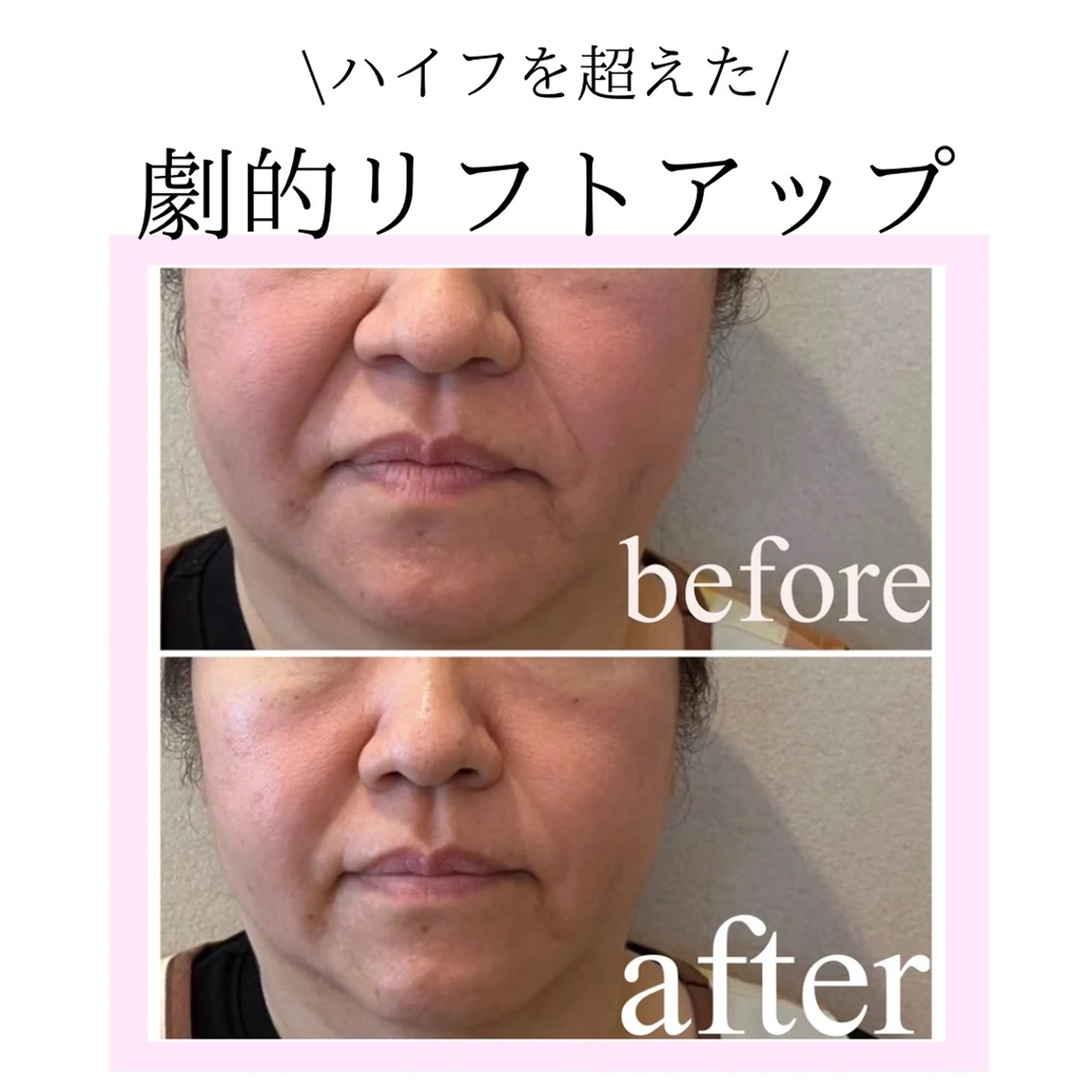 【通常価格40000円以上】💎たるみ・ほうれい線・小顔💎劇的リフトアップ打ち放題の写真