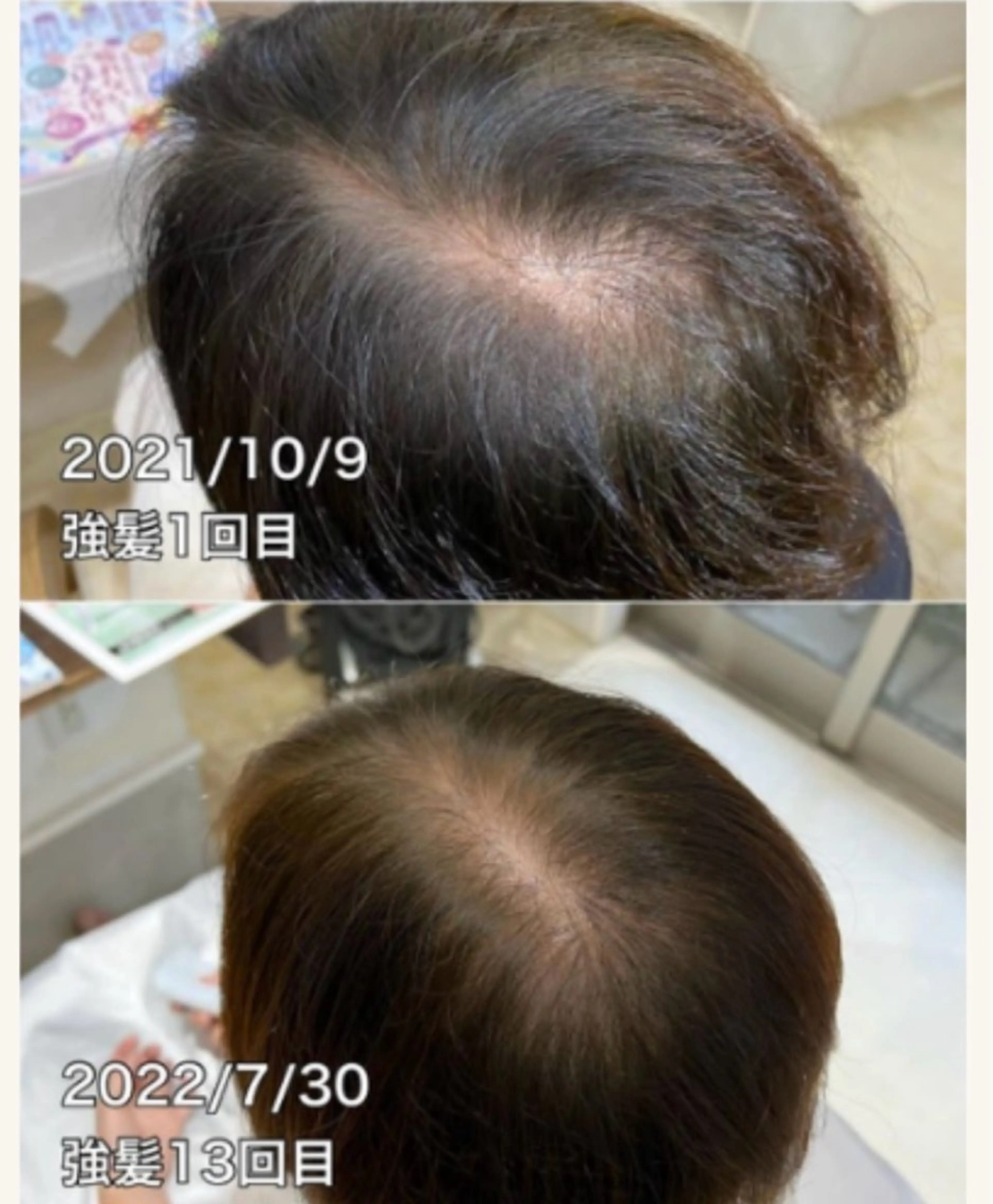 【本気のヘッドケア】ヘッドスパ＋強髪（超高濃度ヒト幹細胞110%）髪のボリュームアップ、髪艶の写真