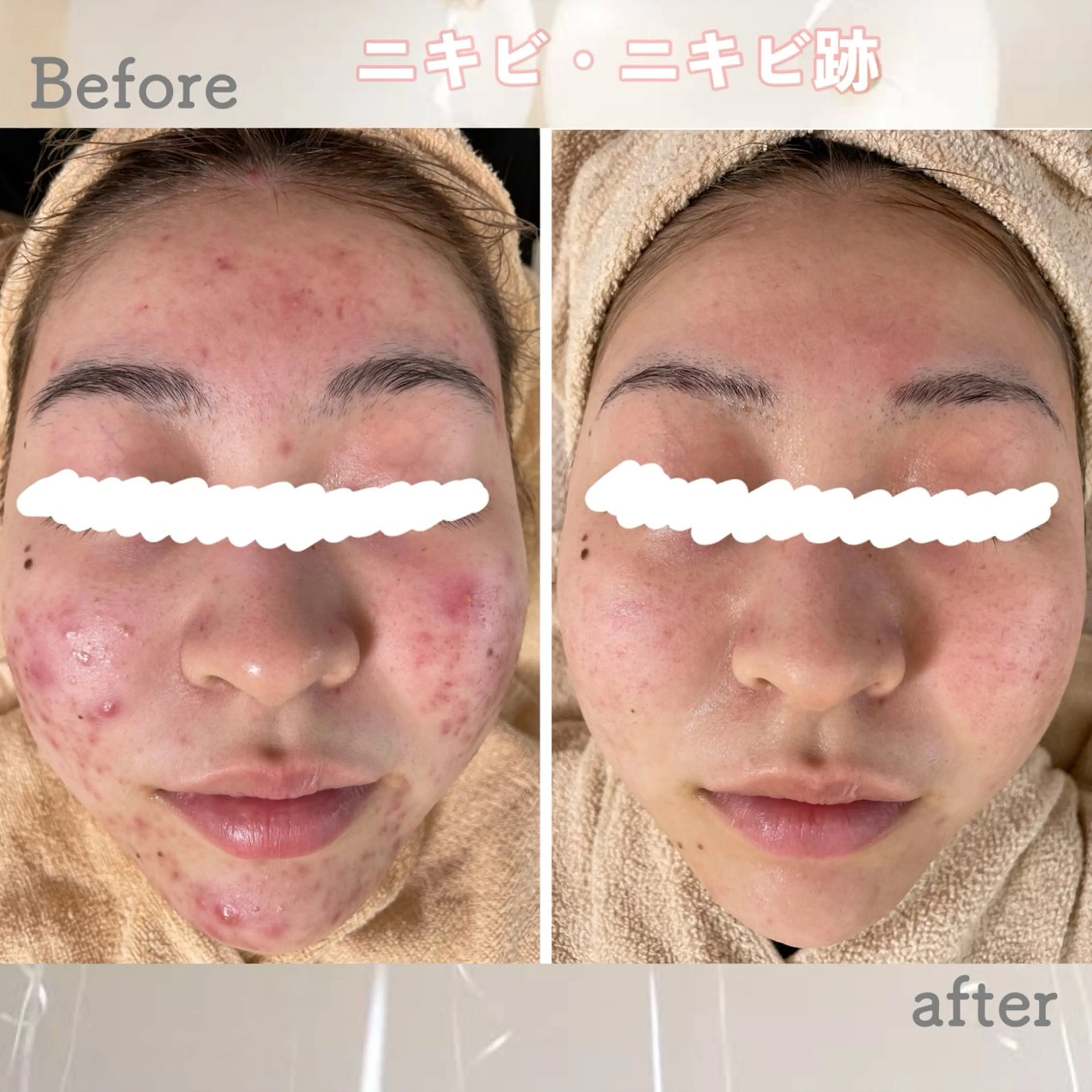 エステ ニキビ&跡改善サロン オーナー光木のエステ・リラクイメージ