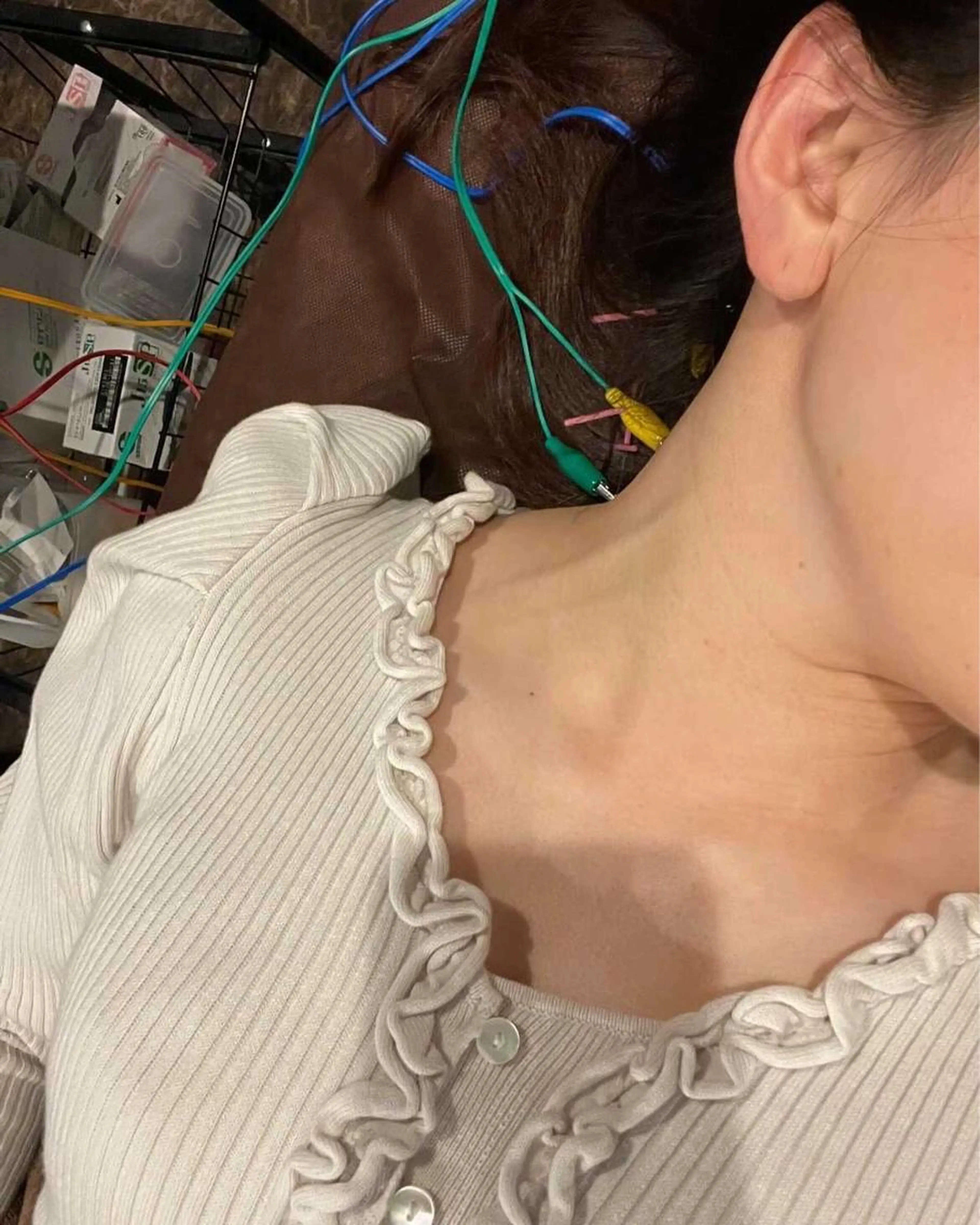 ⭐️当店人気第1位⭐️初回美容鍼(肩周り鍼施術付⭐️12000→10000☆ハロウィン迄期間限定価格☆の写真