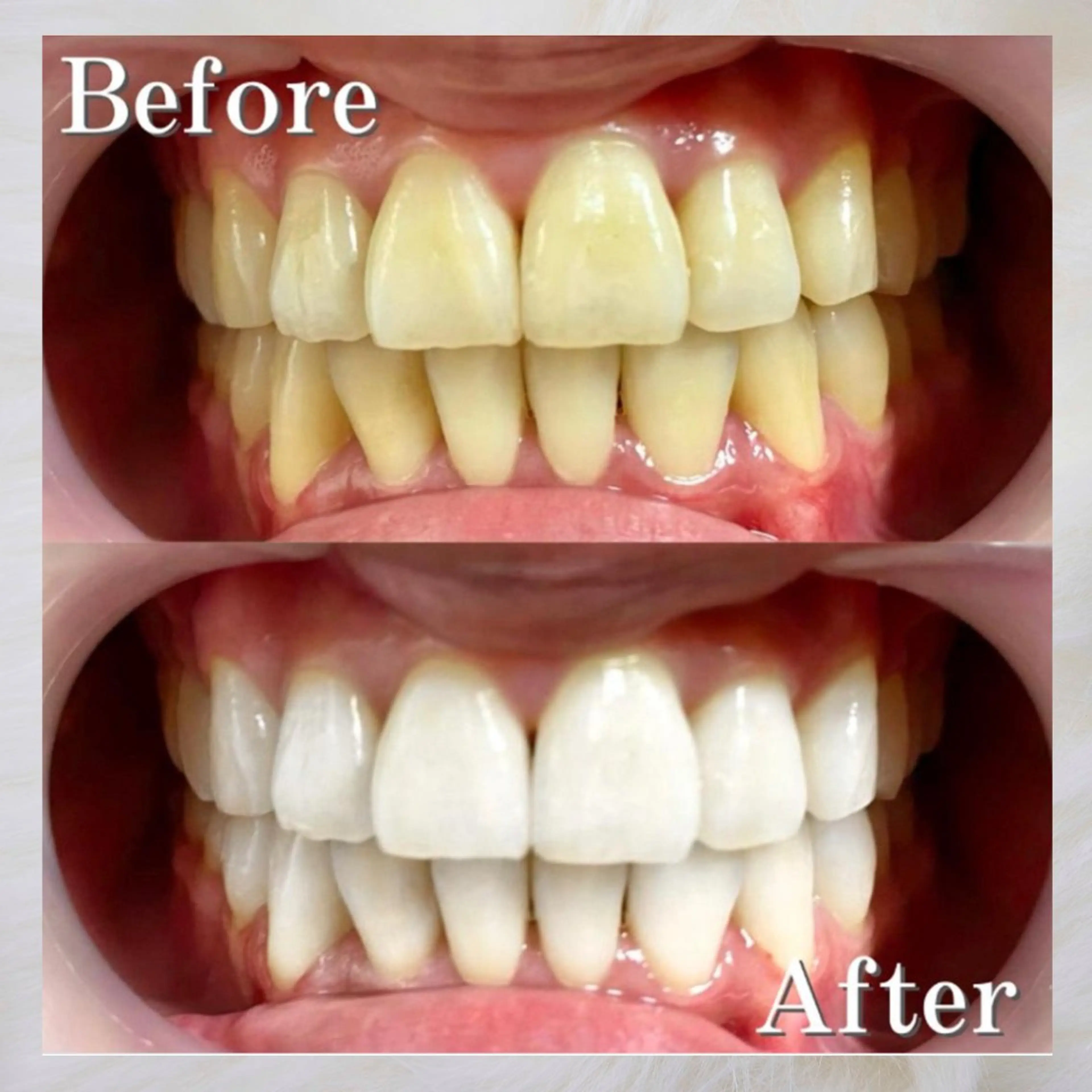 【当日限定】美容day白い歯になりたい方❣️時短🌟痛くない🦷ホワイトニング8分×2(通常￥8800の写真