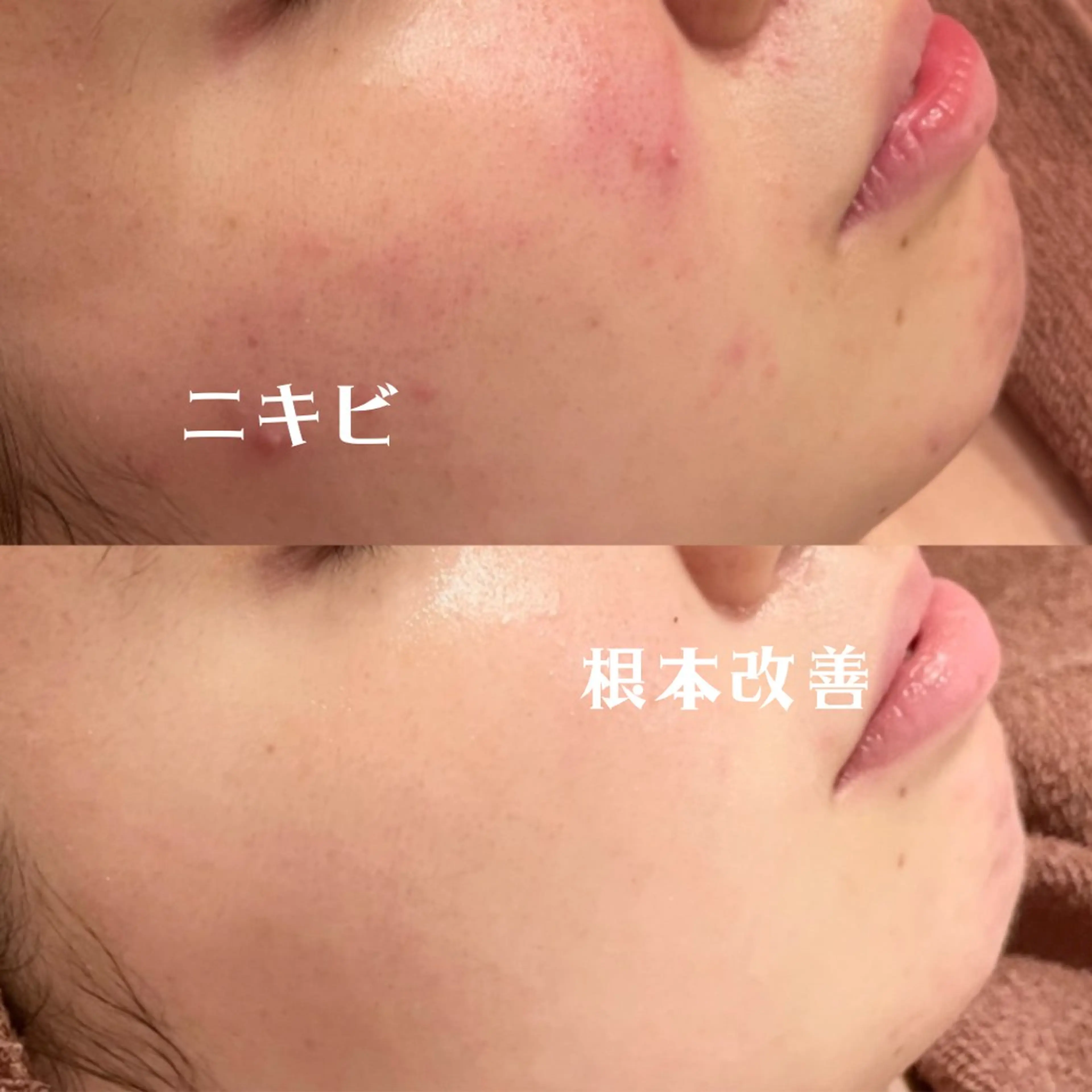 【当日SALE❕❕✨】肌負担0ピーリング&温熱イオンパックでニキビ撃退コース❕❕🤎の写真