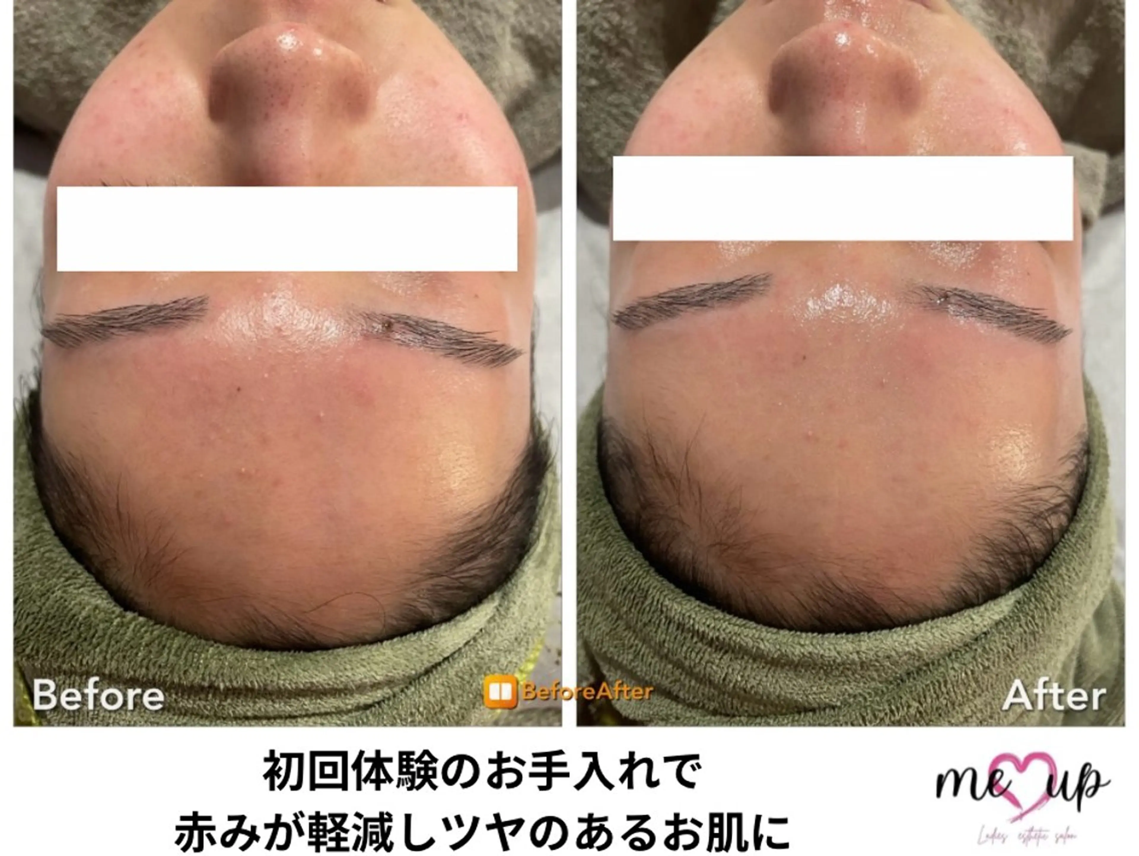 エステ Meupニキビ専門店 背中/ハーブ/肌管理のその他イメージ