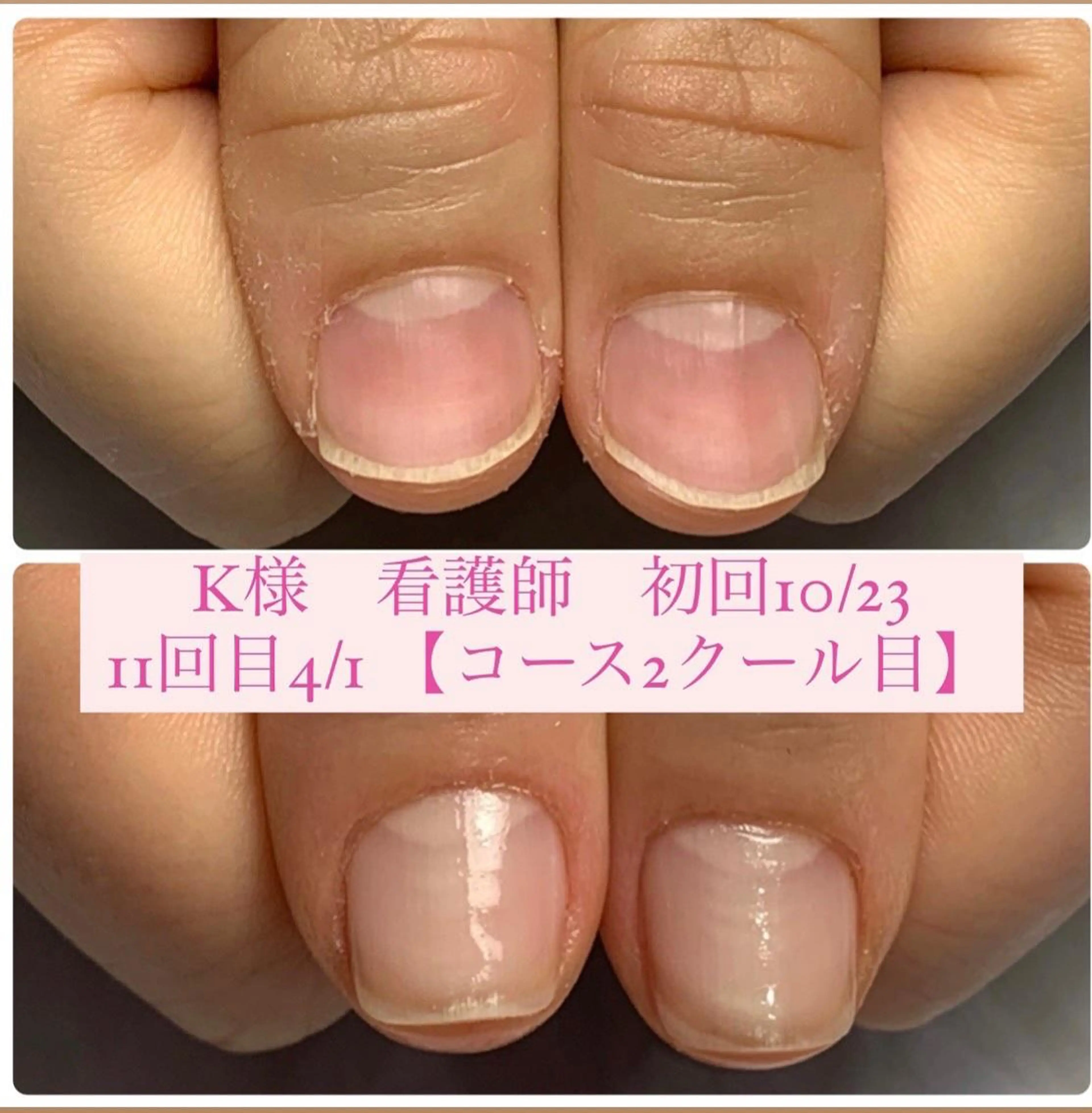 ネイル 自爪育成/深爪矯正 mikiのネイルデザイン