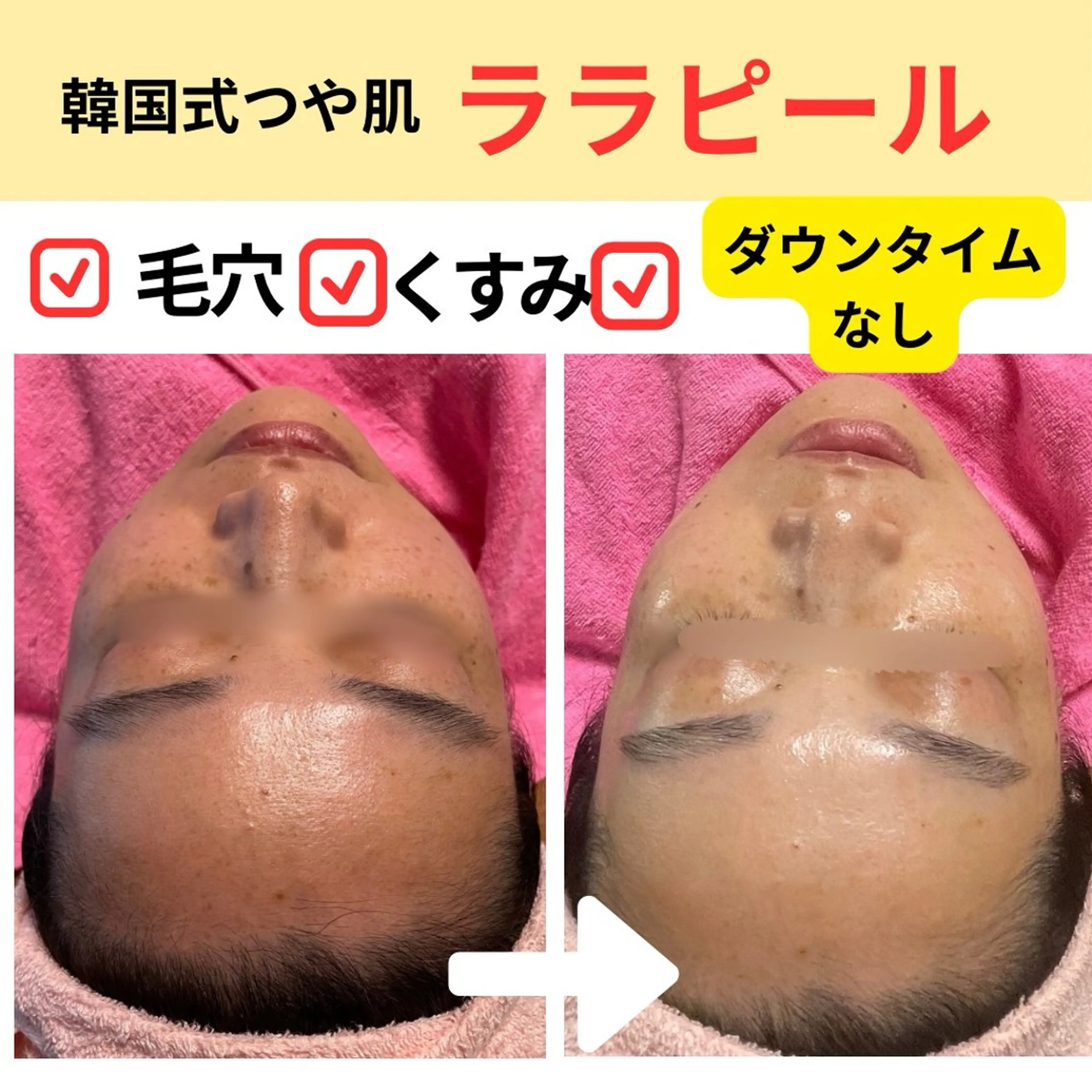 韓国肌&ララピール シミケア　せんすのエステ・リラクイメージ