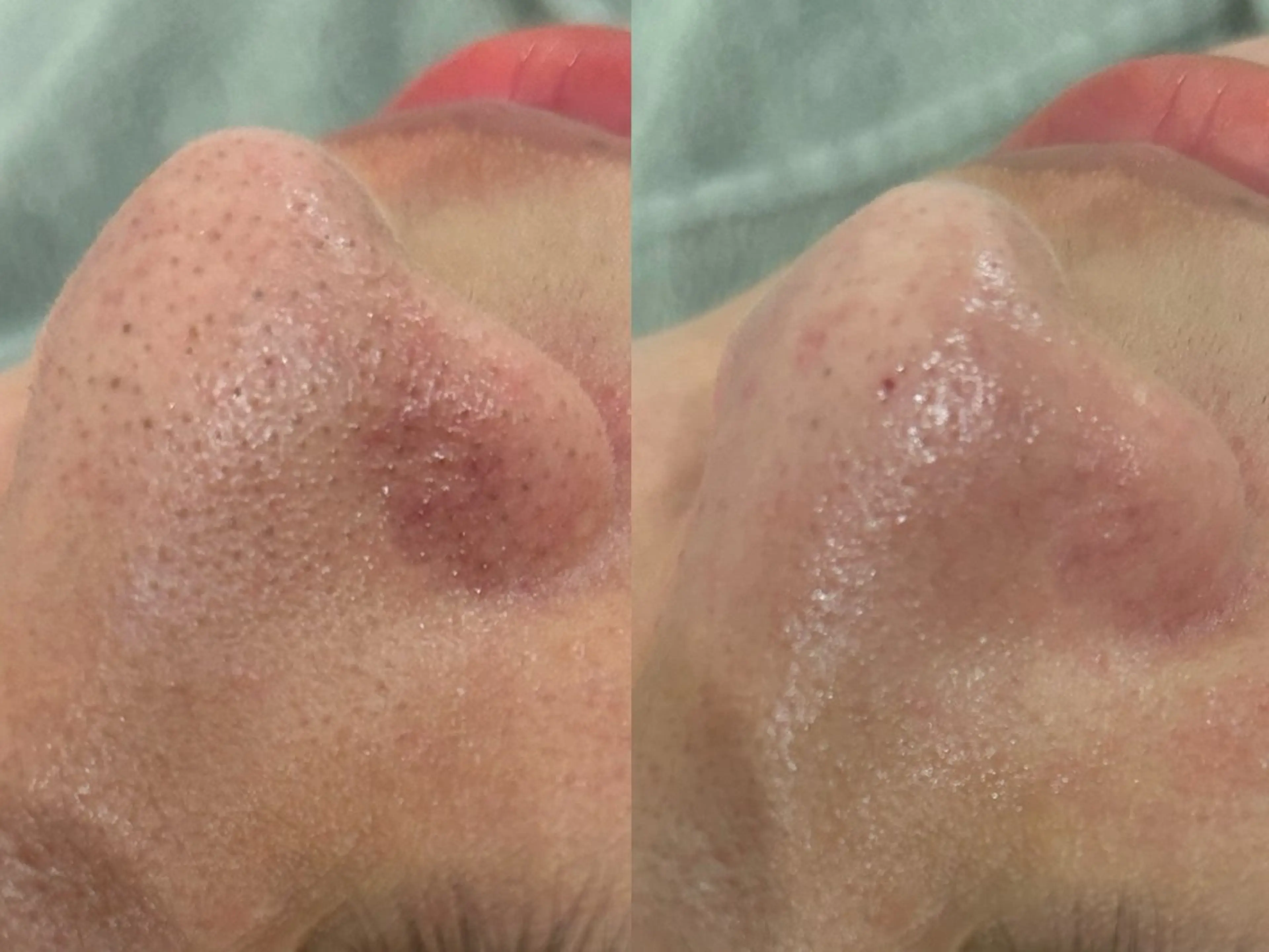 【毛穴洗浄💧】毛穴の汚れごっそり洗浄🪄🫧の写真