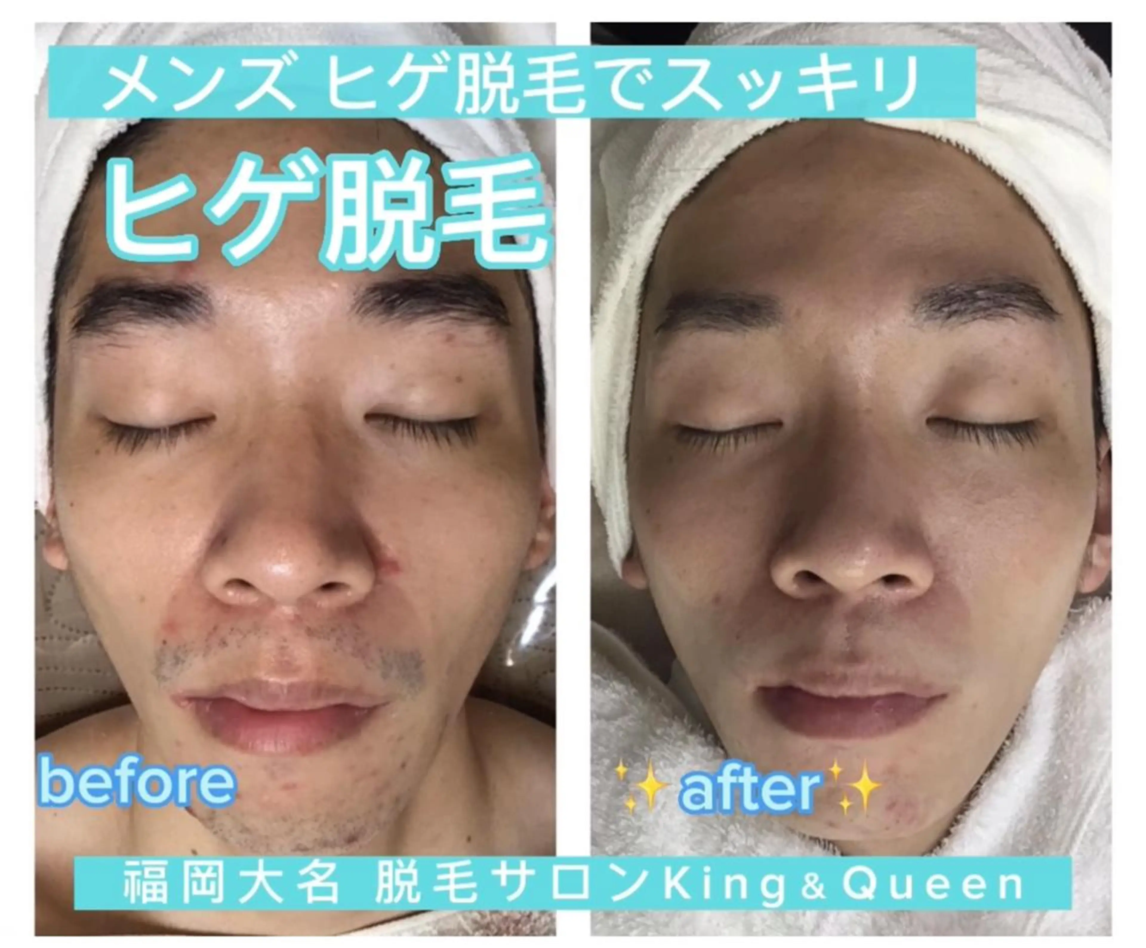 12/24～12/28年末4日間限定ヒゲ脱毛0円の写真