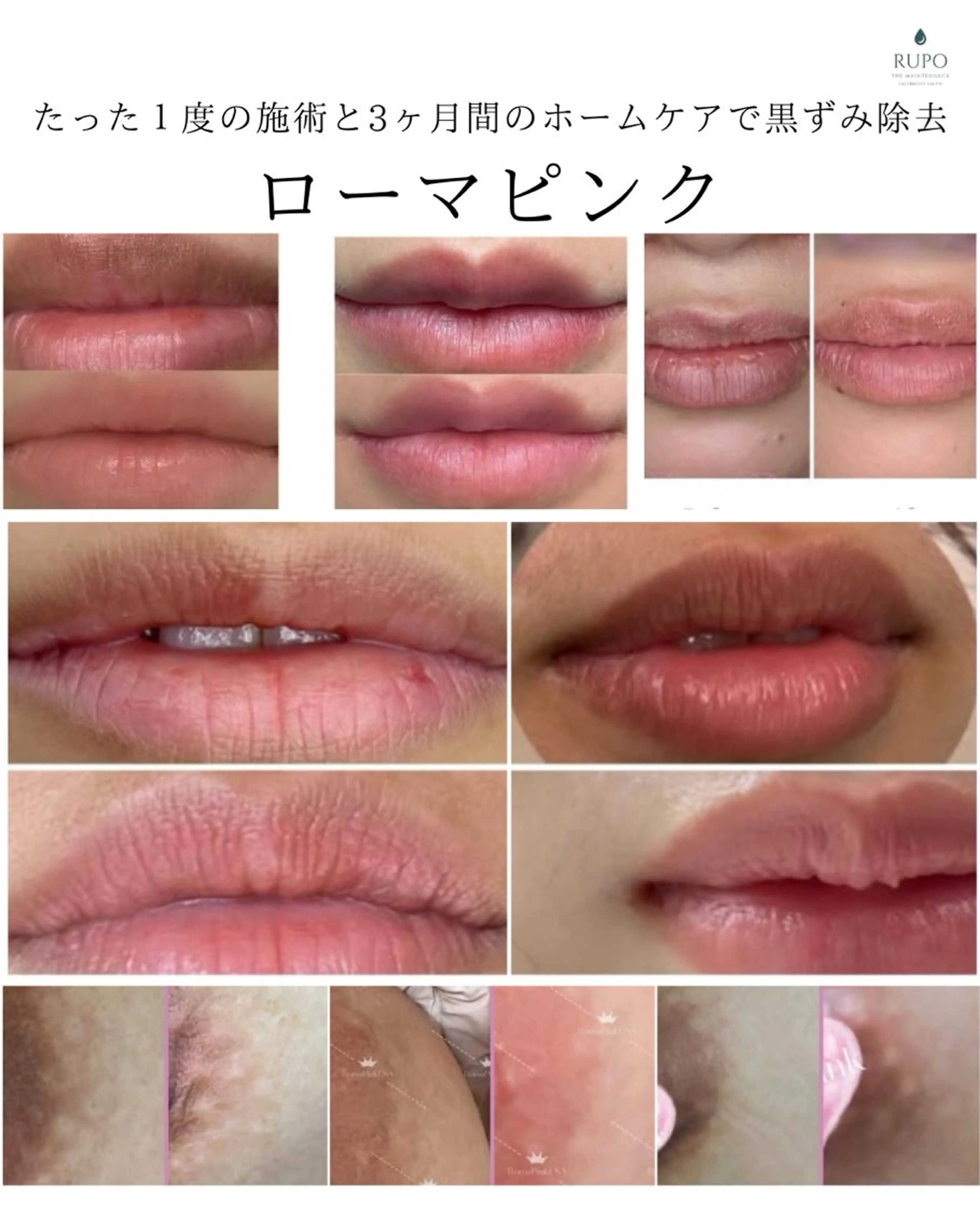 【唇ローマピンク】カウンセリング無料・当日施術可。通常204600/モニター125400の写真