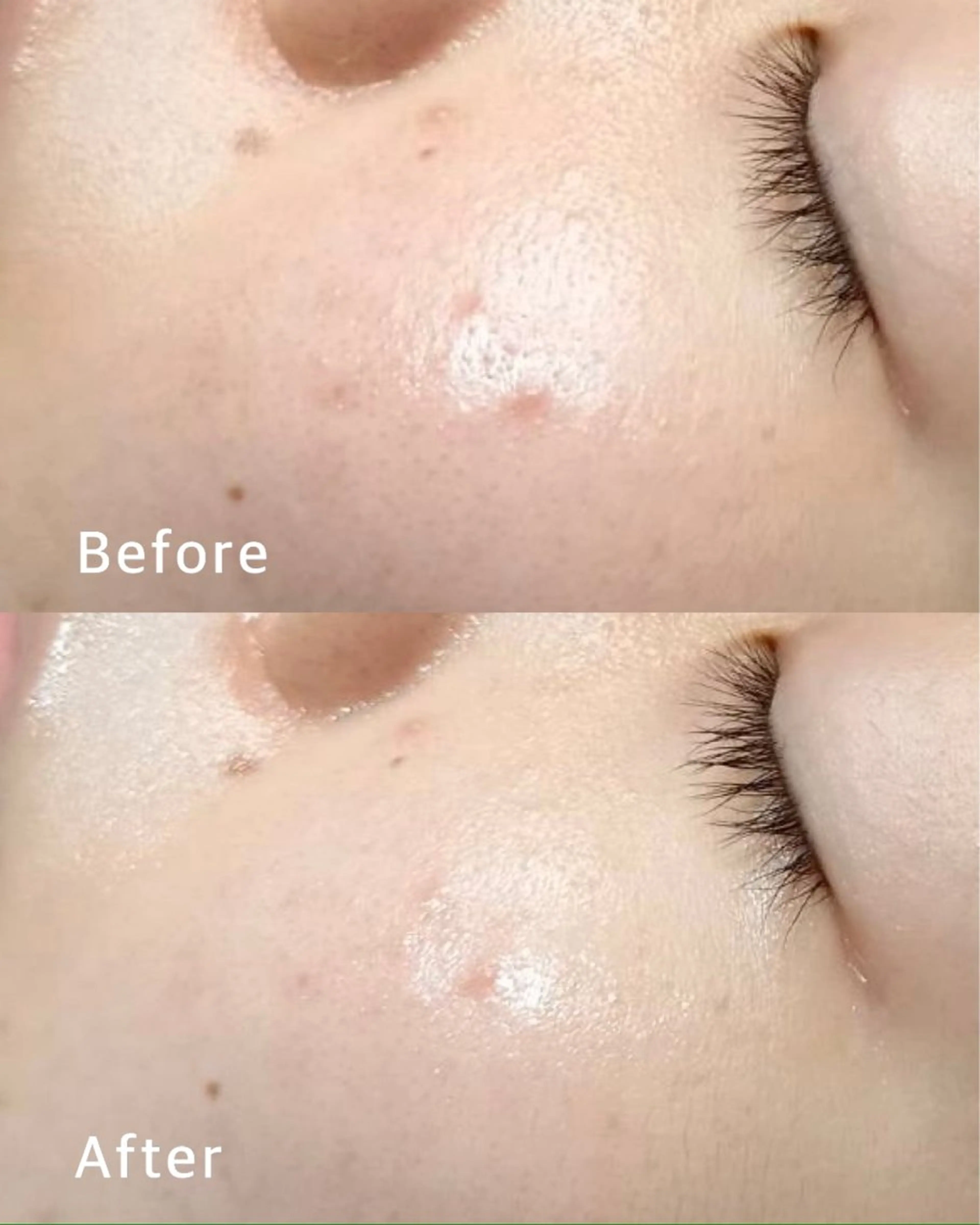 minimo限定🌟世界初の特許技術✨FAITH生コラーゲンフェイシャルエステの写真