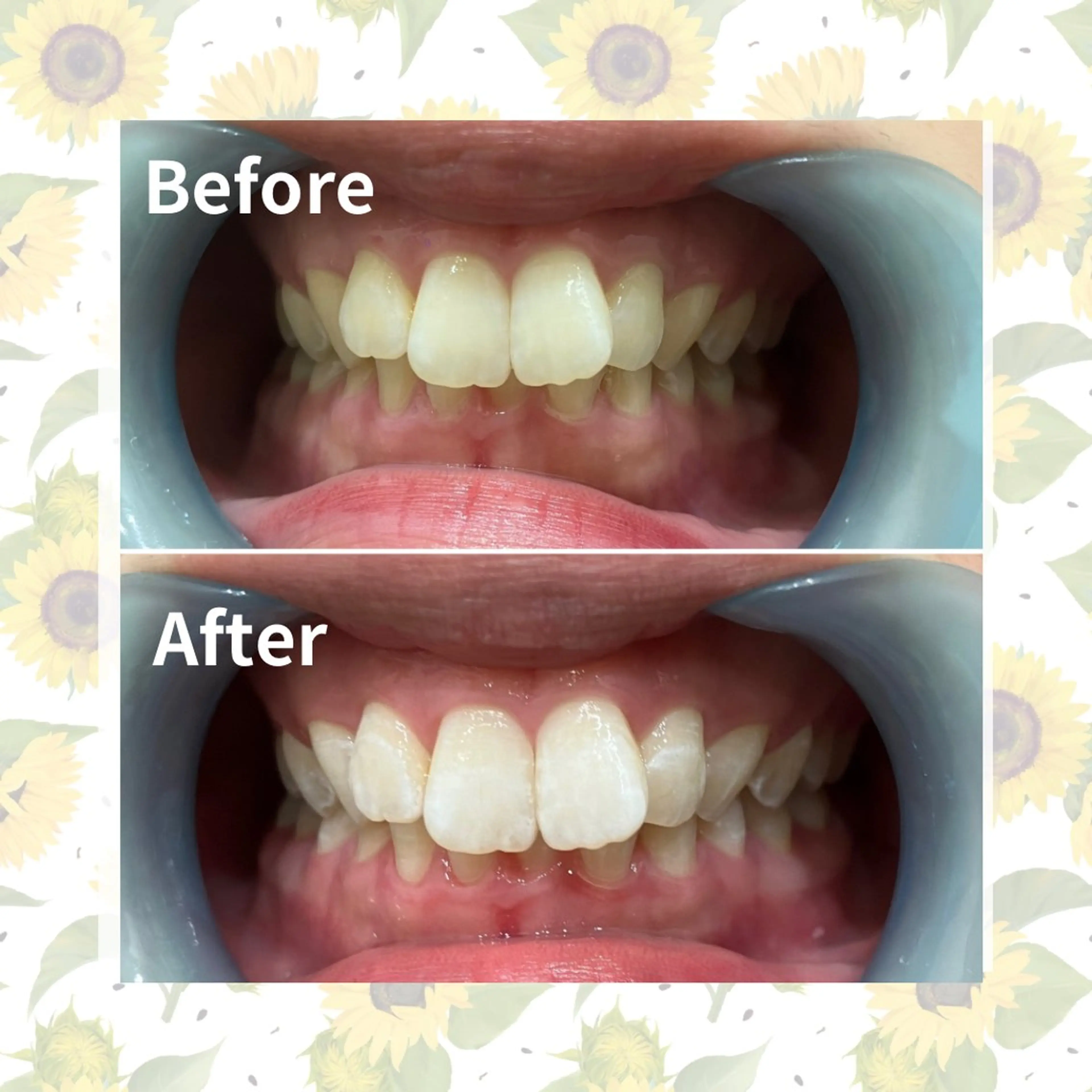 セルフホワイトニング 『Luster』のその他イメージ