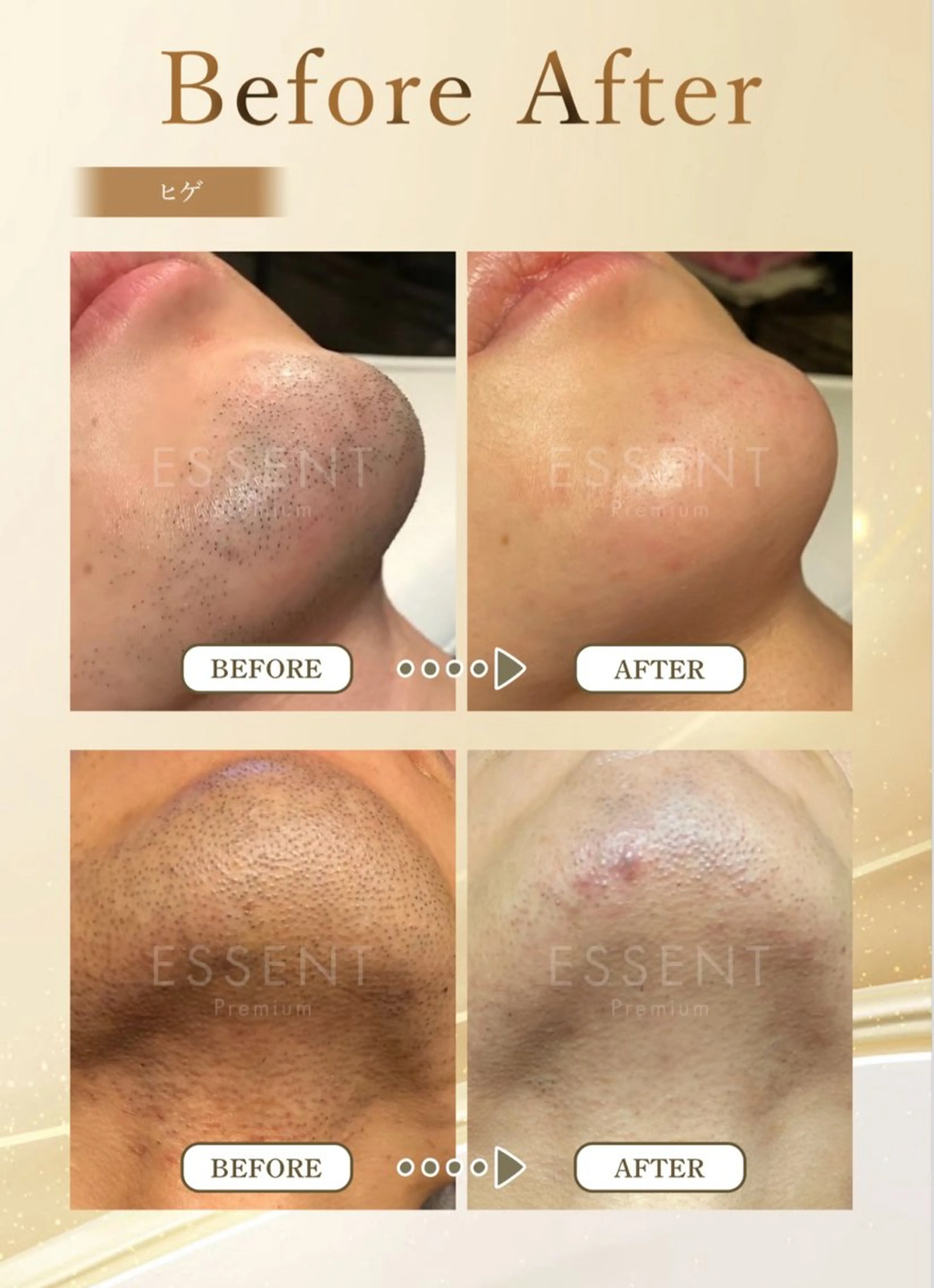 メンズヒゲ脱毛（ヒゲ全部+眉毛周り+小鼻）の写真