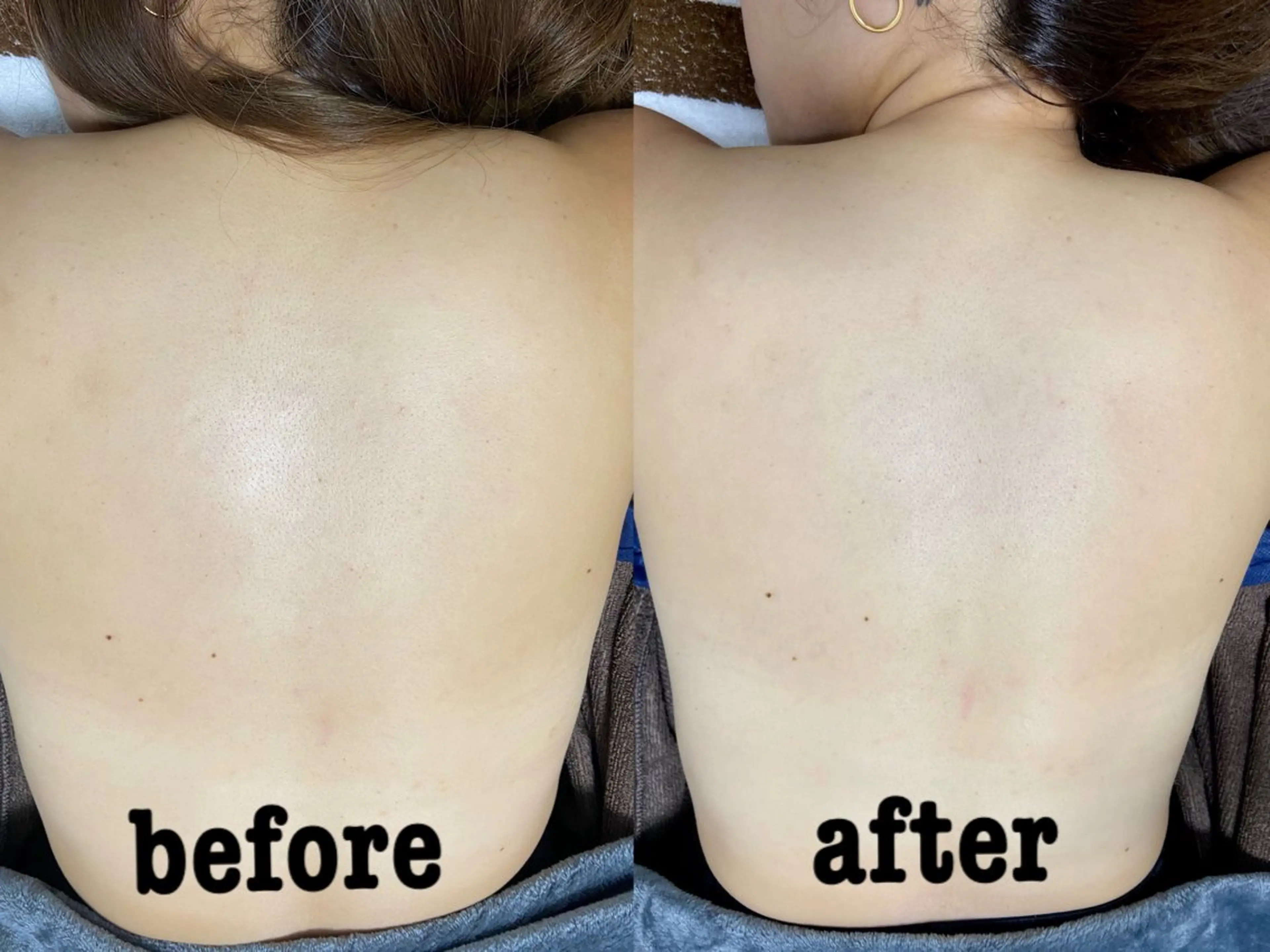 背中のニキビケア✨✨の写真