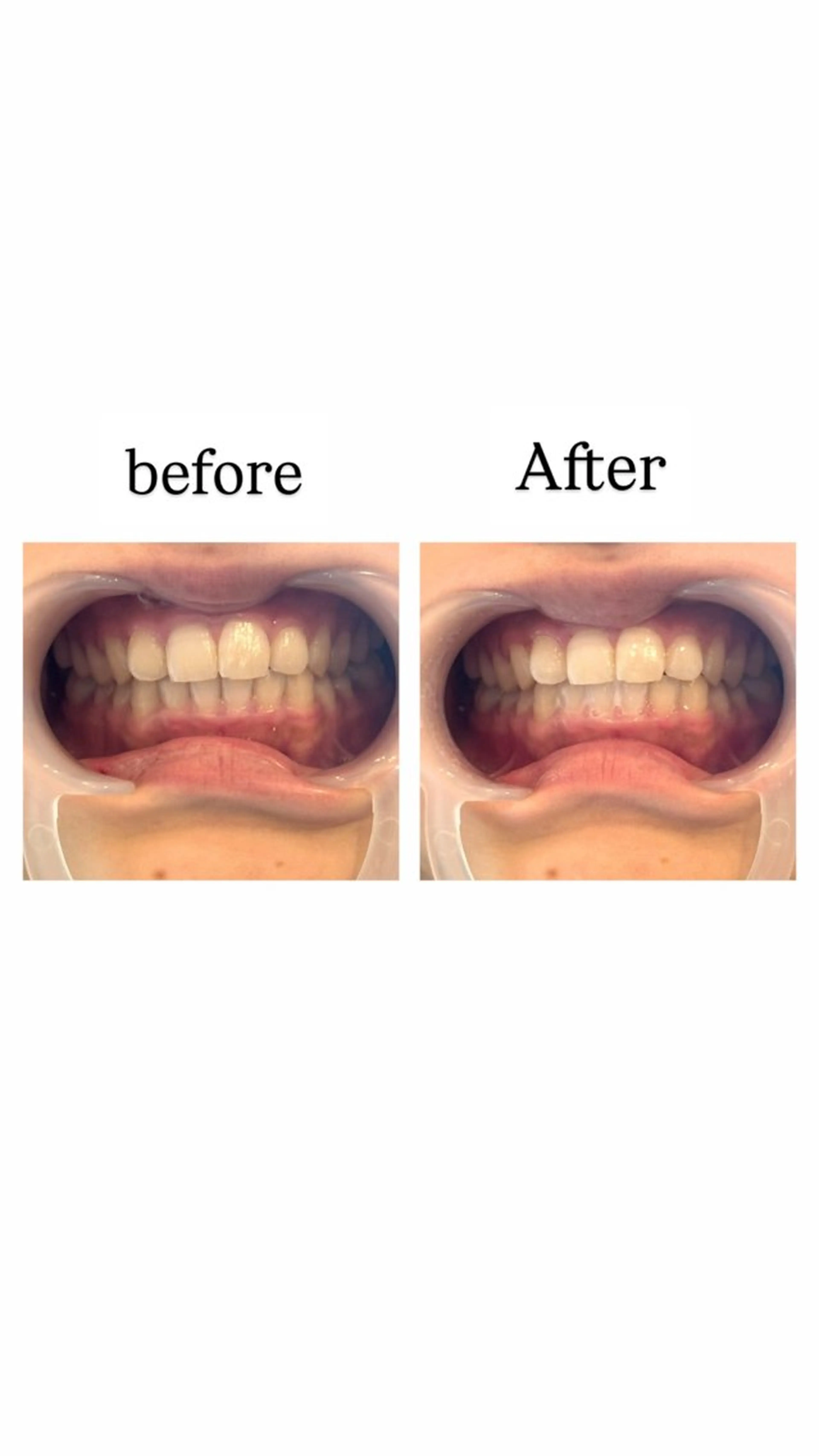 【✨️🦷セルフホワイトニング🦷✨️】イベント前の方必見の写真