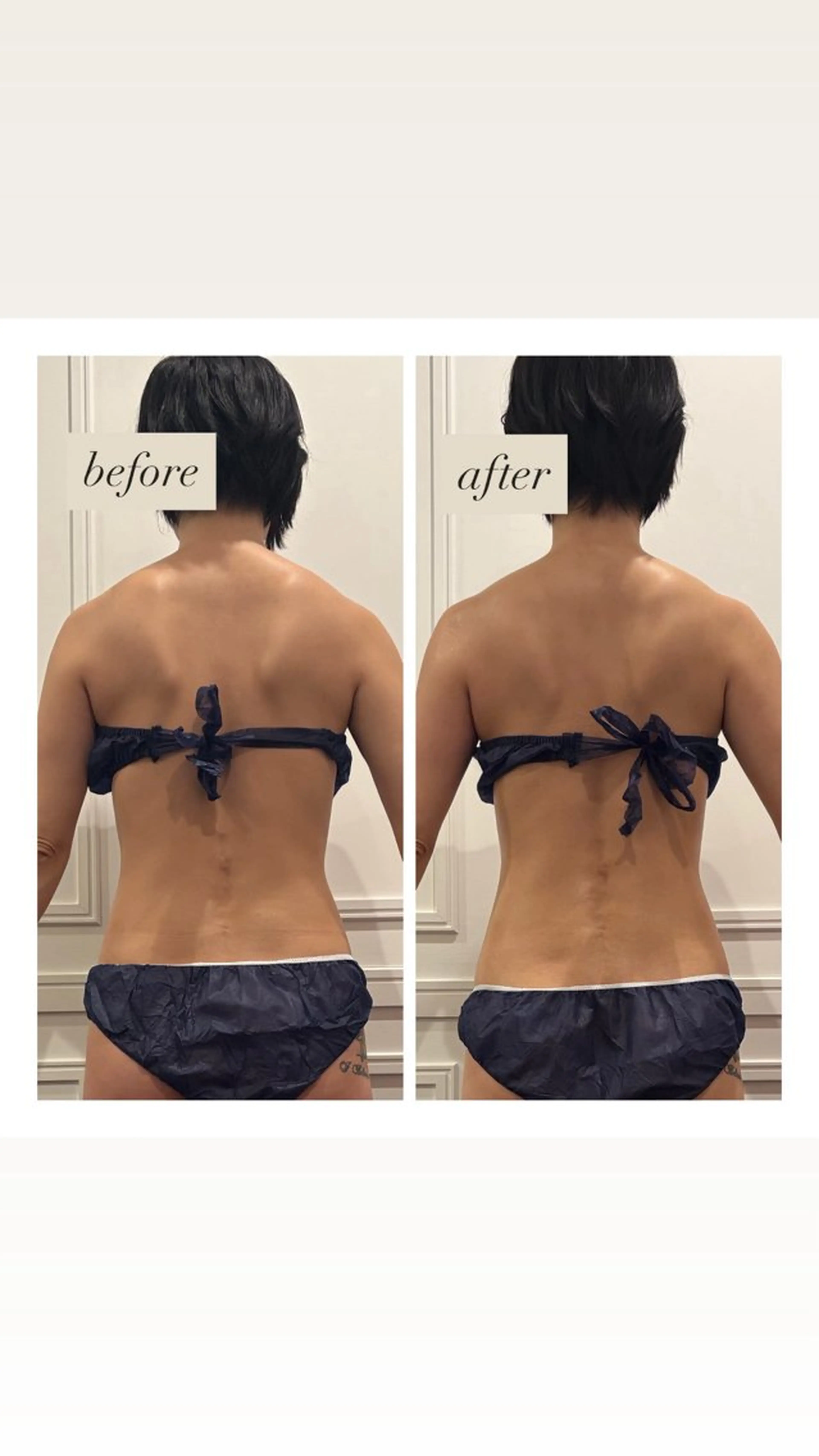 ー12月限定メニュー🎅🏻🎄ー 【背中痩せ集中】しつこい背中の脂肪や肩こりでお悩みの方におすすめ！ハイパーナイフEXの写真