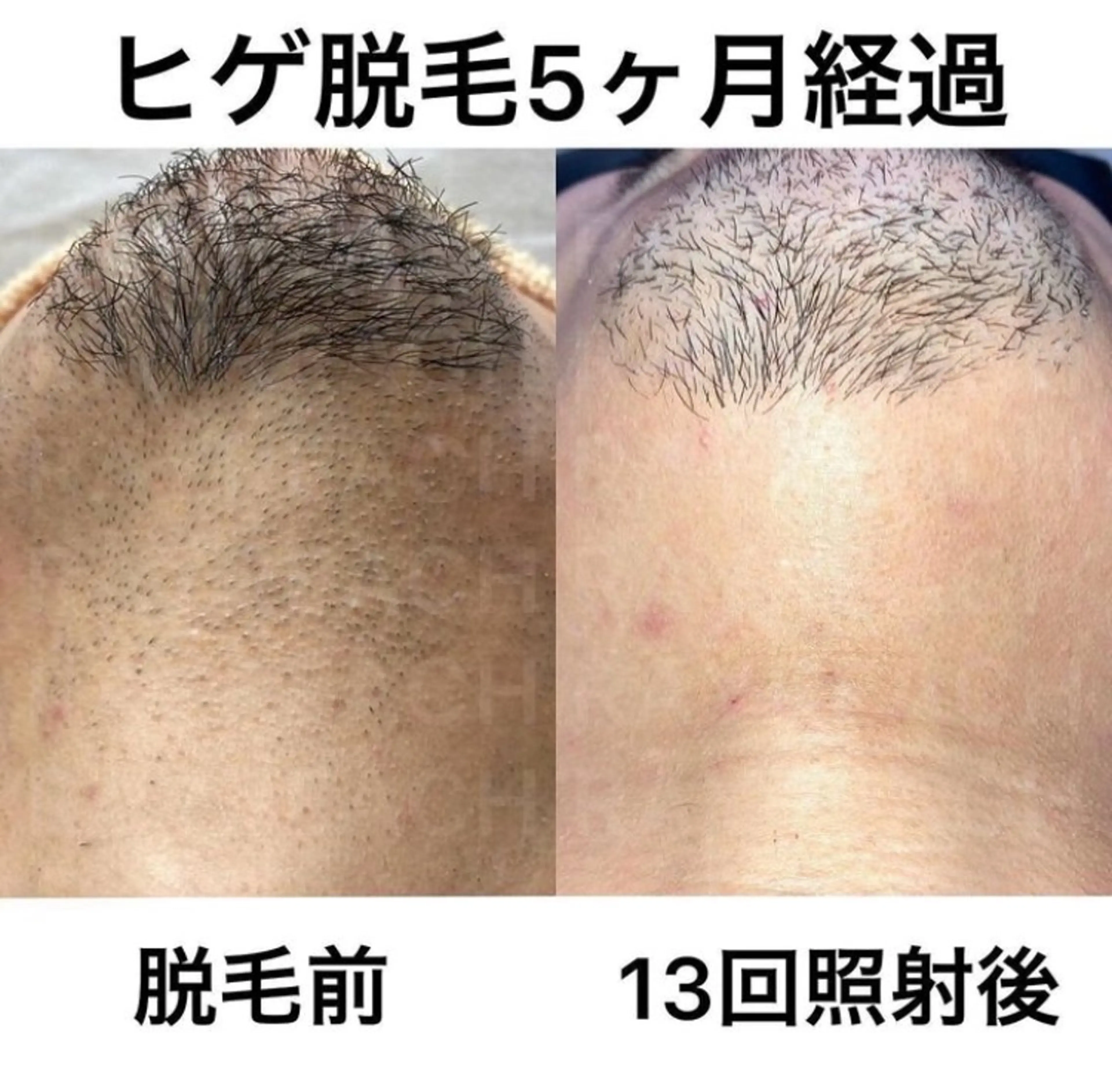 メンズ限定！髭脱毛！！しぶとい毛とおさらばしませんか？！2回5000円or4回で9000円！激安です！の写真