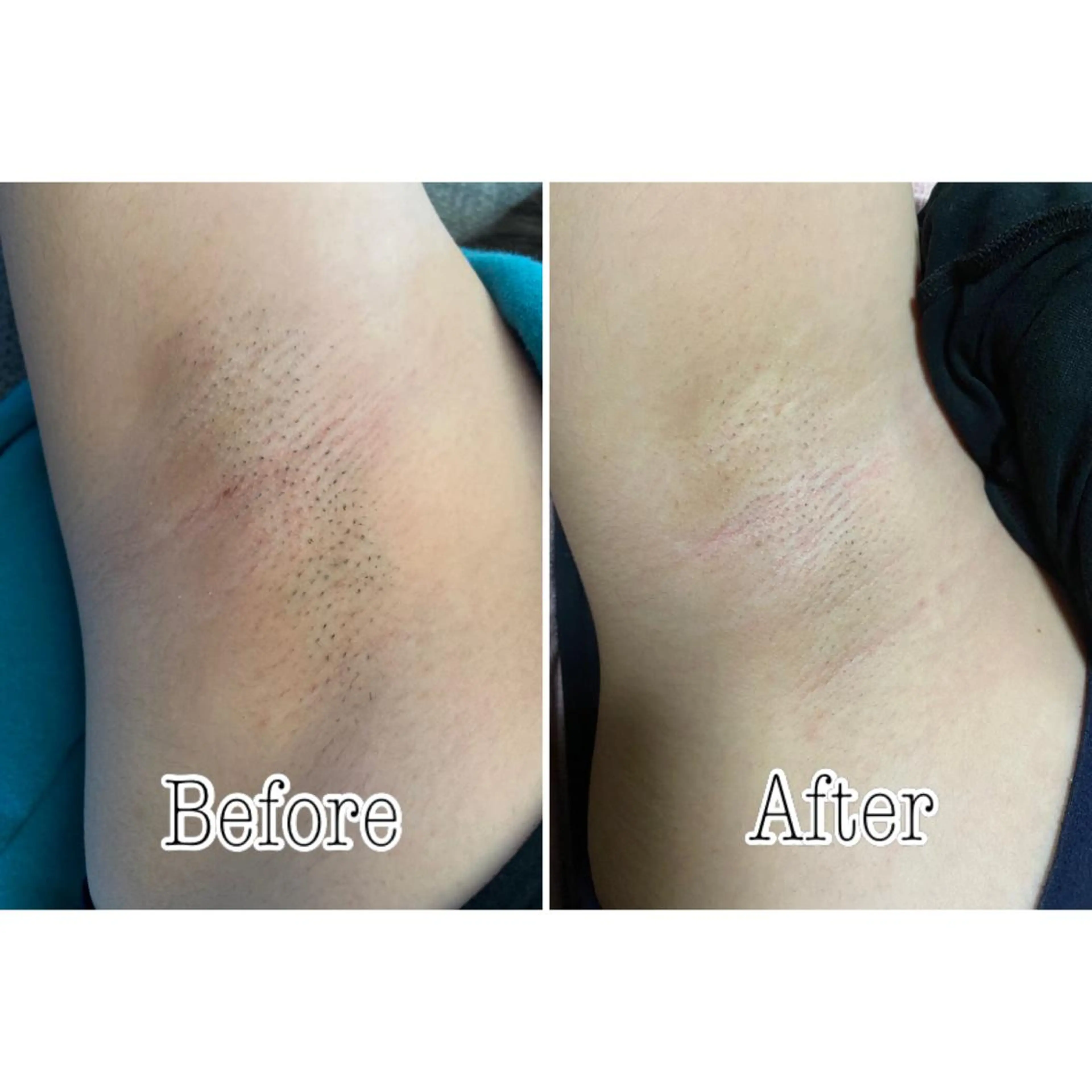 都度払い制脱毛サロンBe Charm所属・Be Charm 山﨑のエステ・リラクイメージ