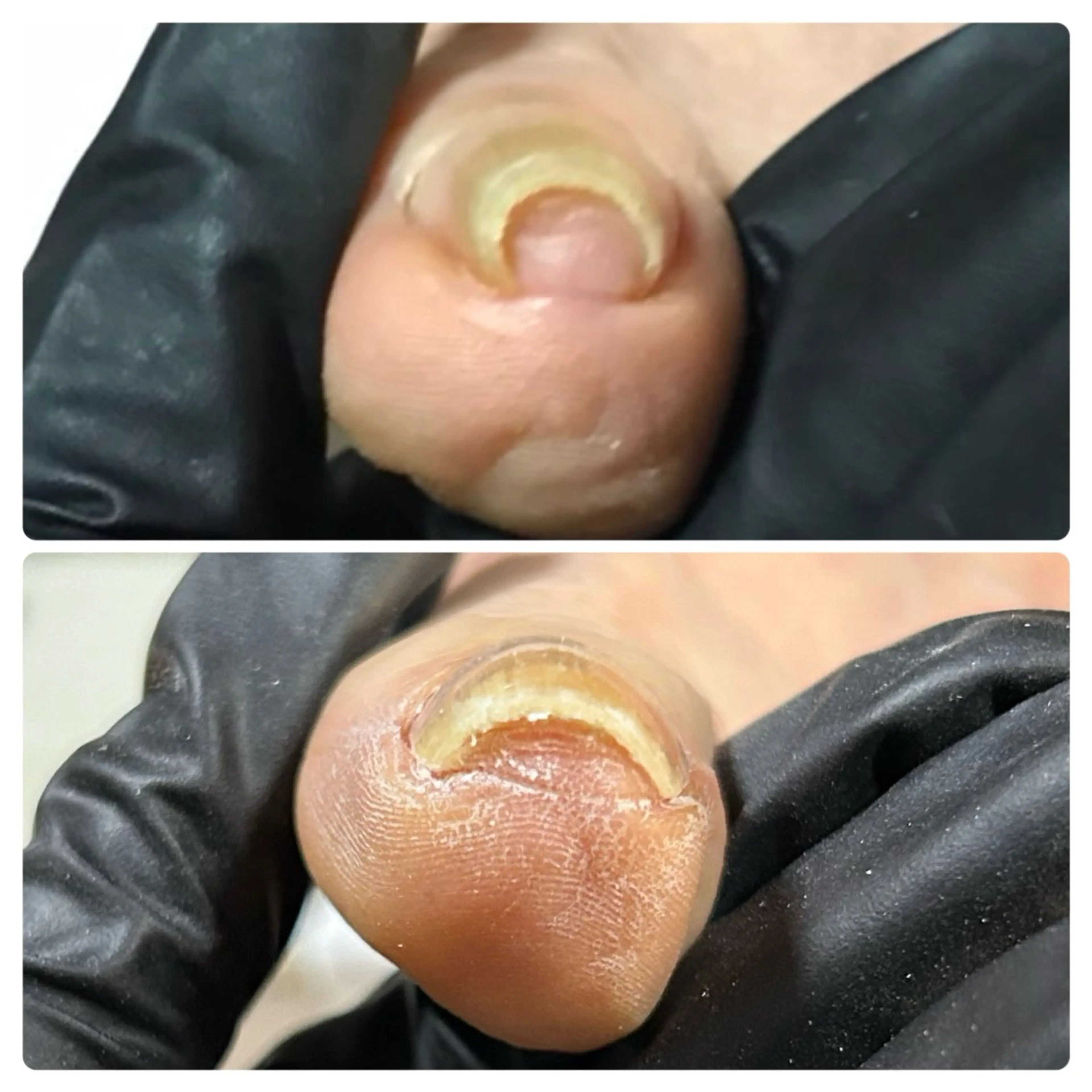 親指 巻き爪ケアの写真