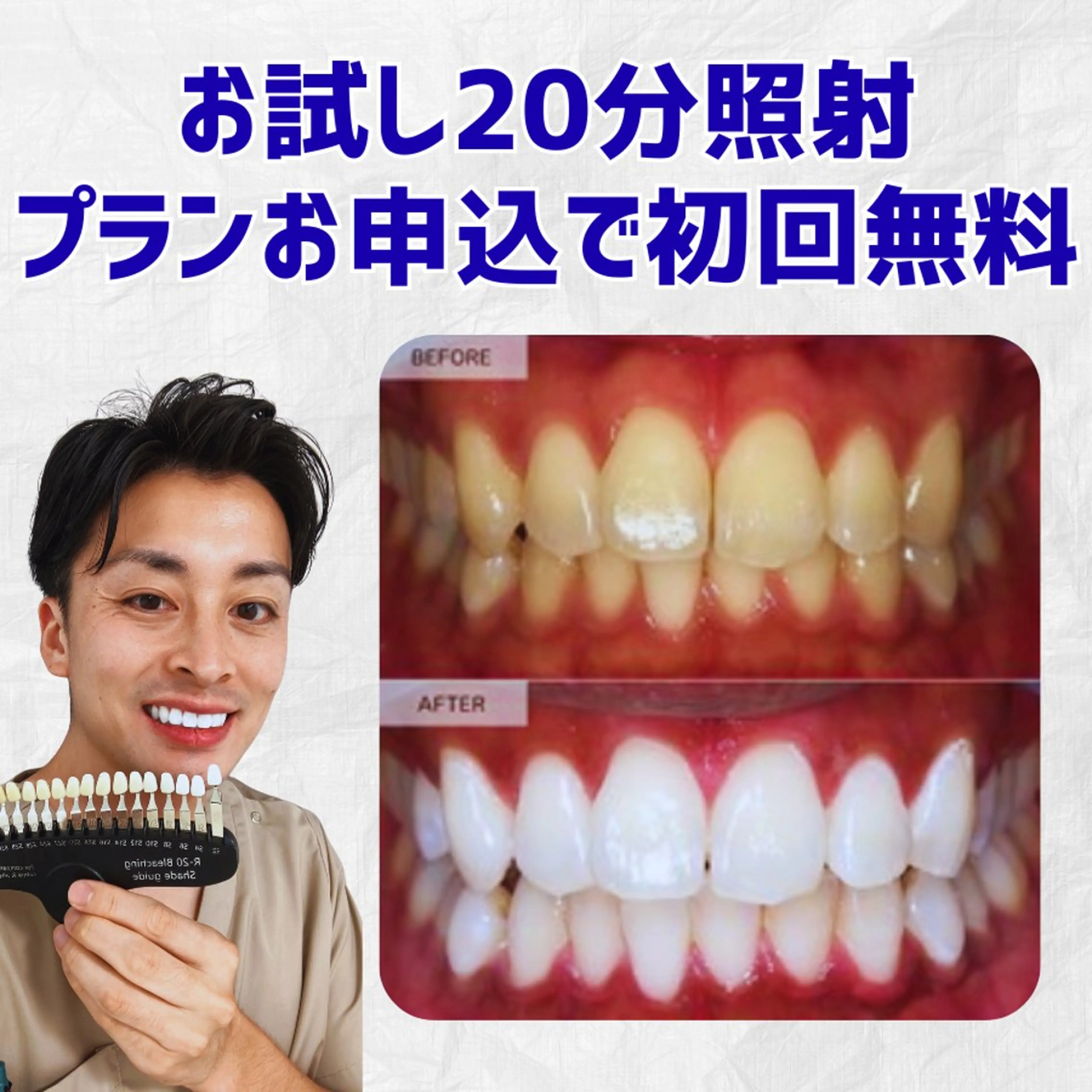 お試し20分照射ホワイトニングの写真