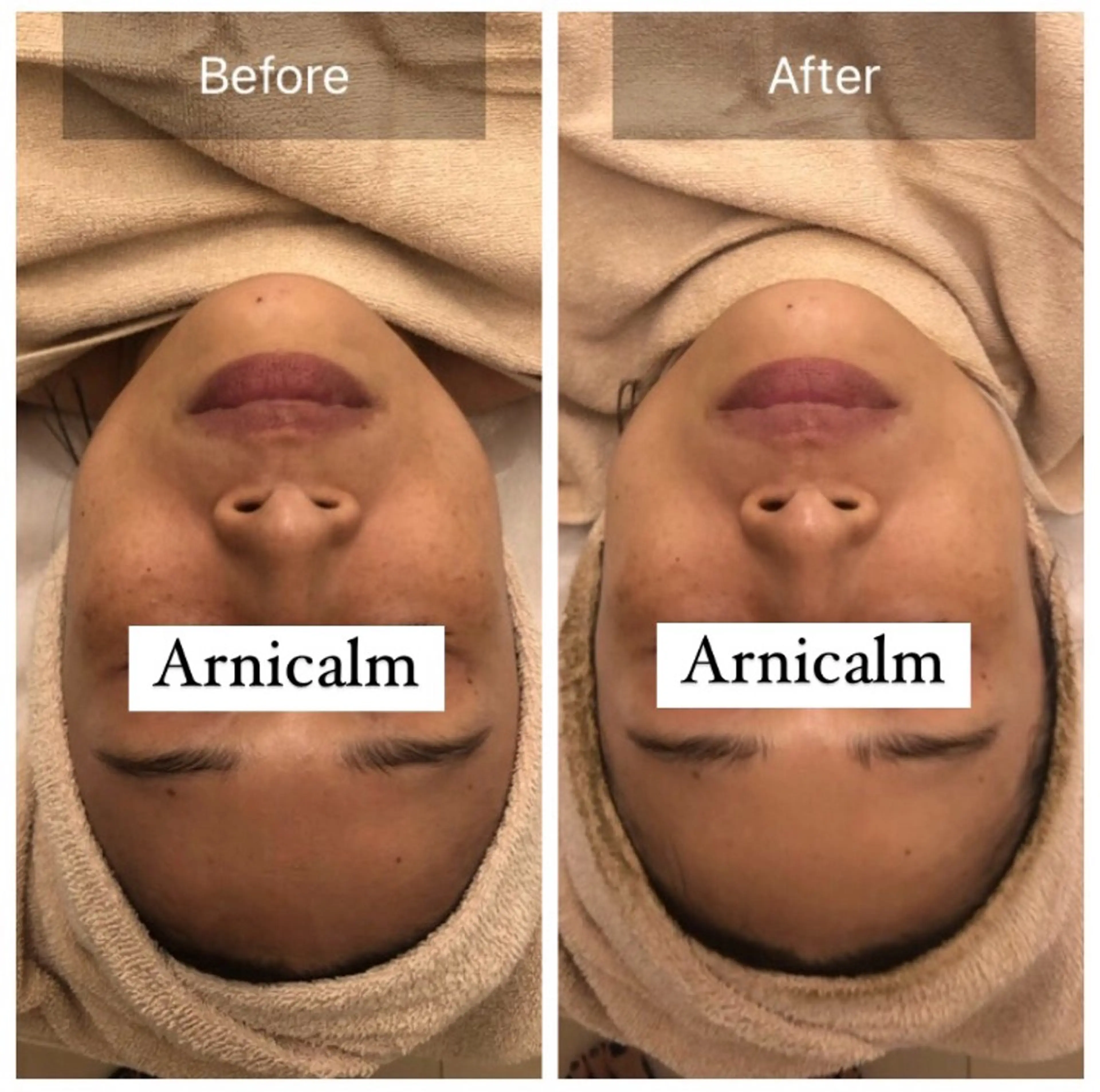 エステ ハーブピーリング 肌再生ピーリング/のエステ・リラクイメージ