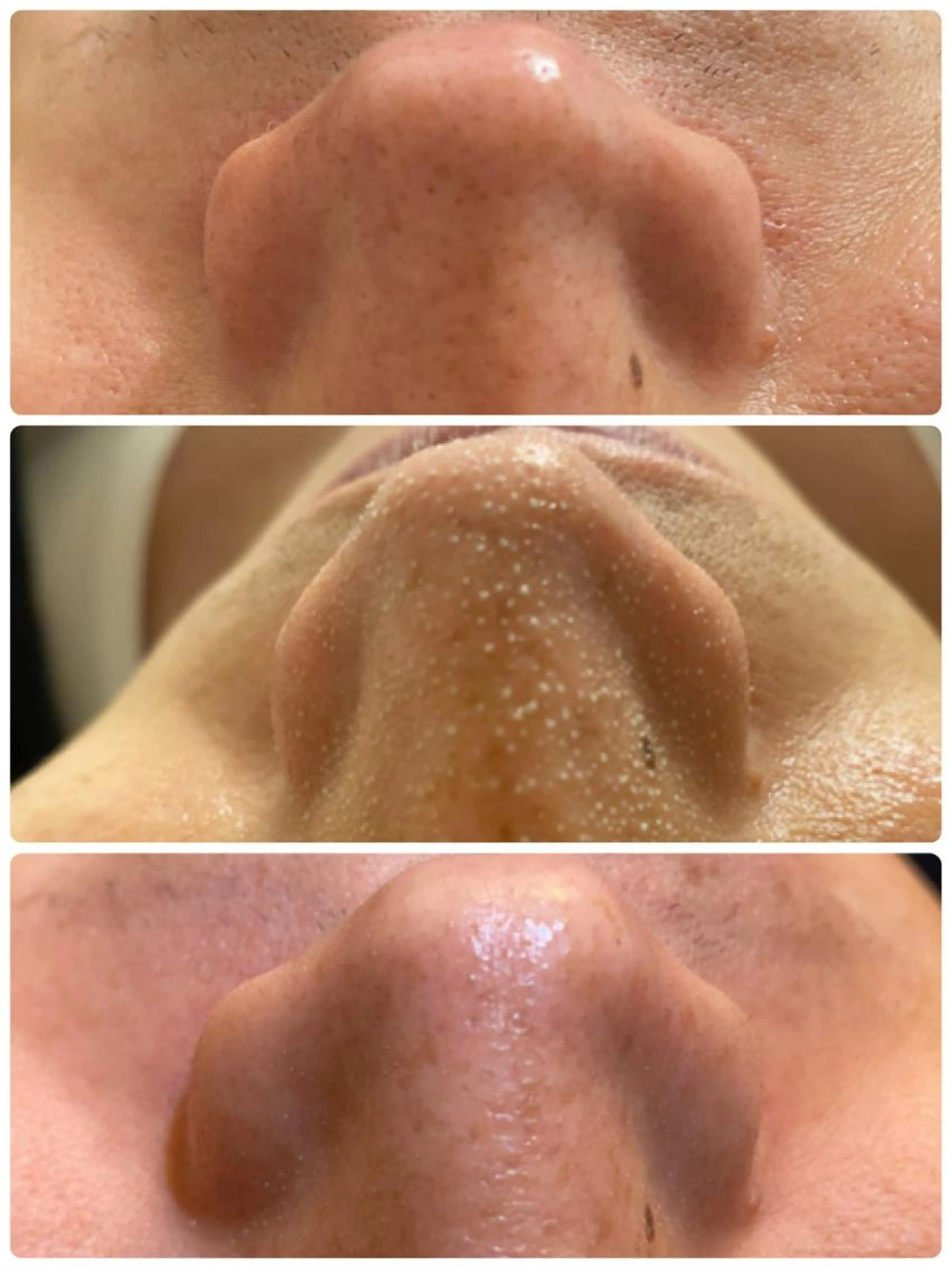 毛穴洗浄!速攻ツルツル本気の毛穴ケアケア🌹当サロン独自の技術を組み合わせ気になるいちご鼻や気になる毛穴を綺麗にします!の写真