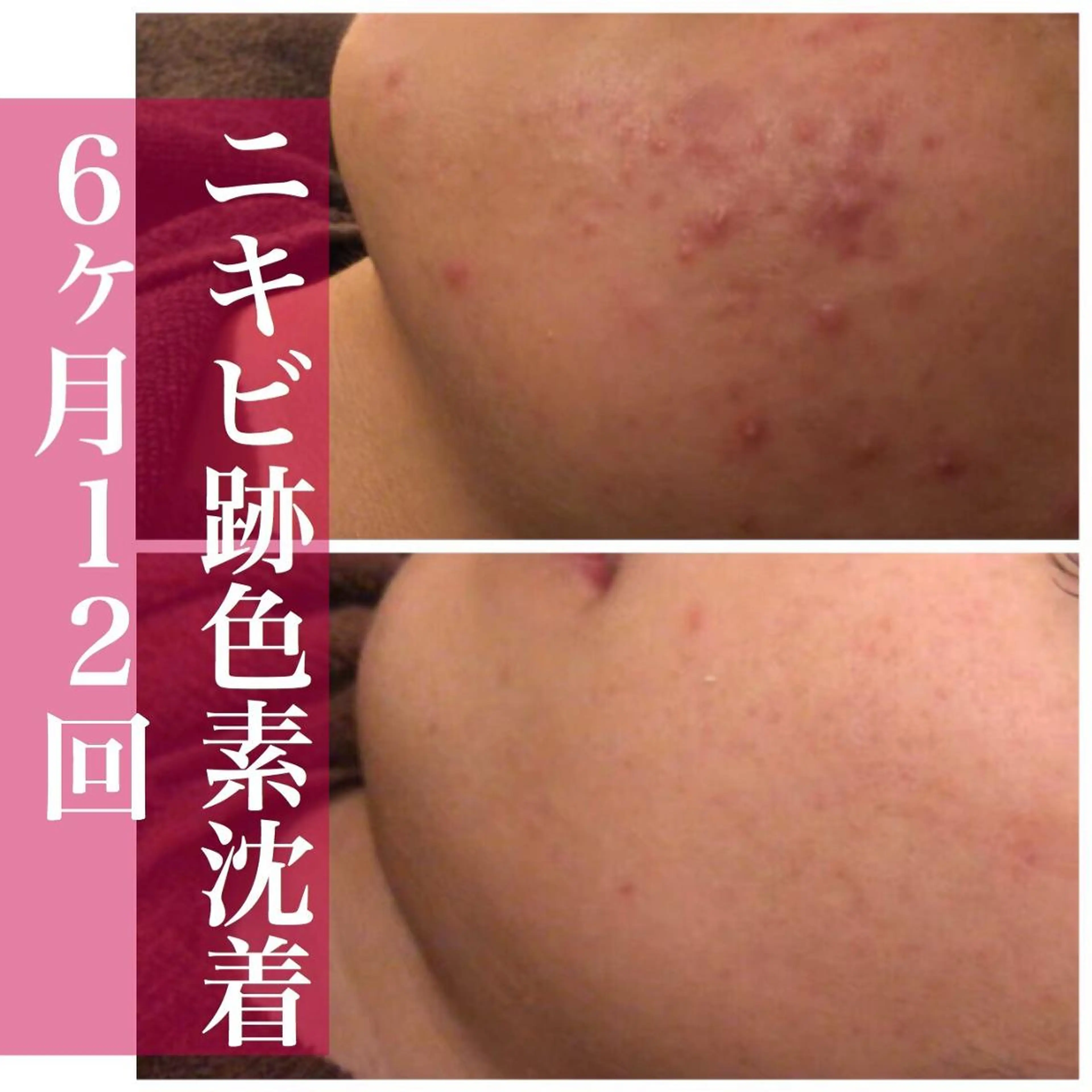 都内で出来る肌管理！ 最短ニキビ改善のエステ・リラクイメージ