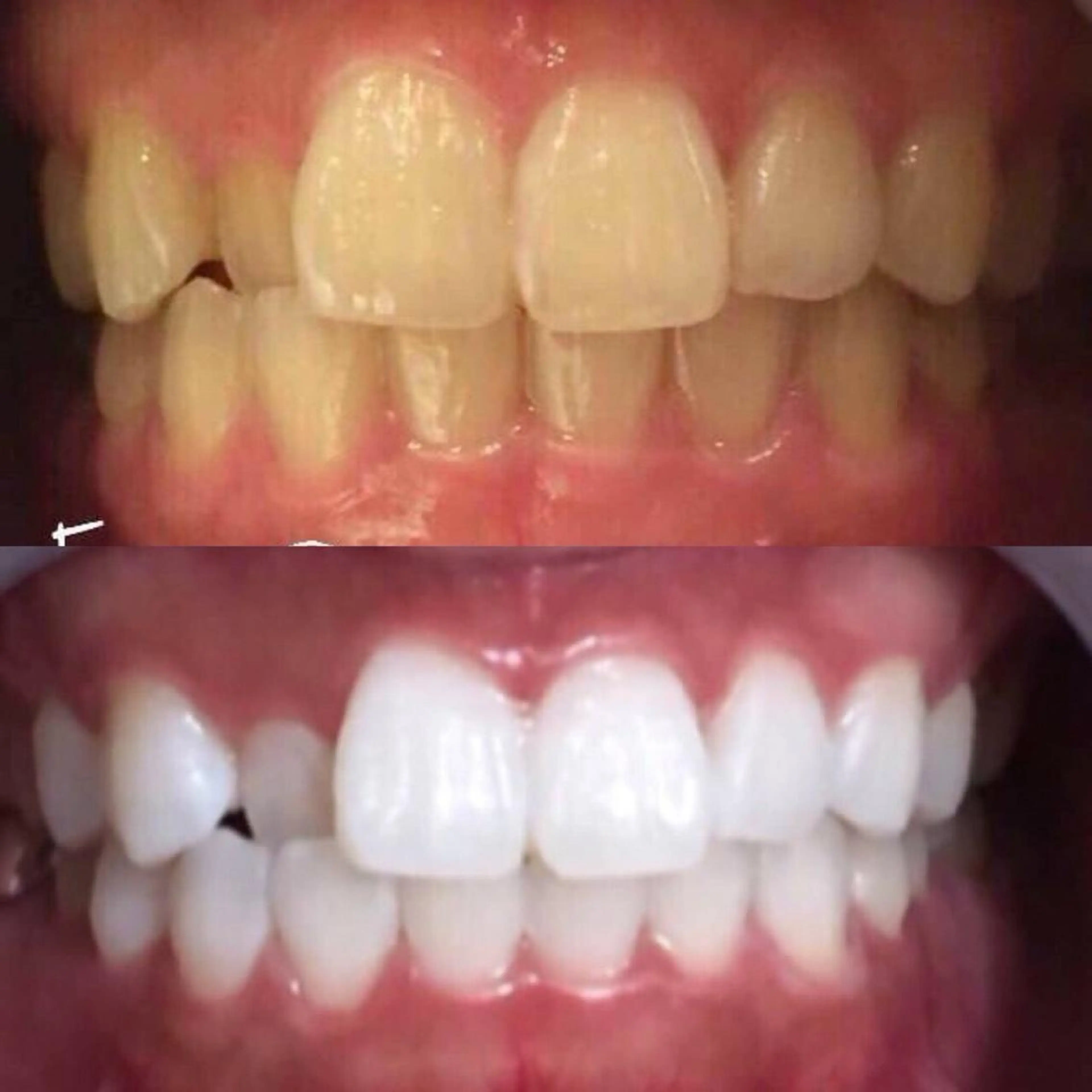 セルフホワイトニング🦷💕の写真