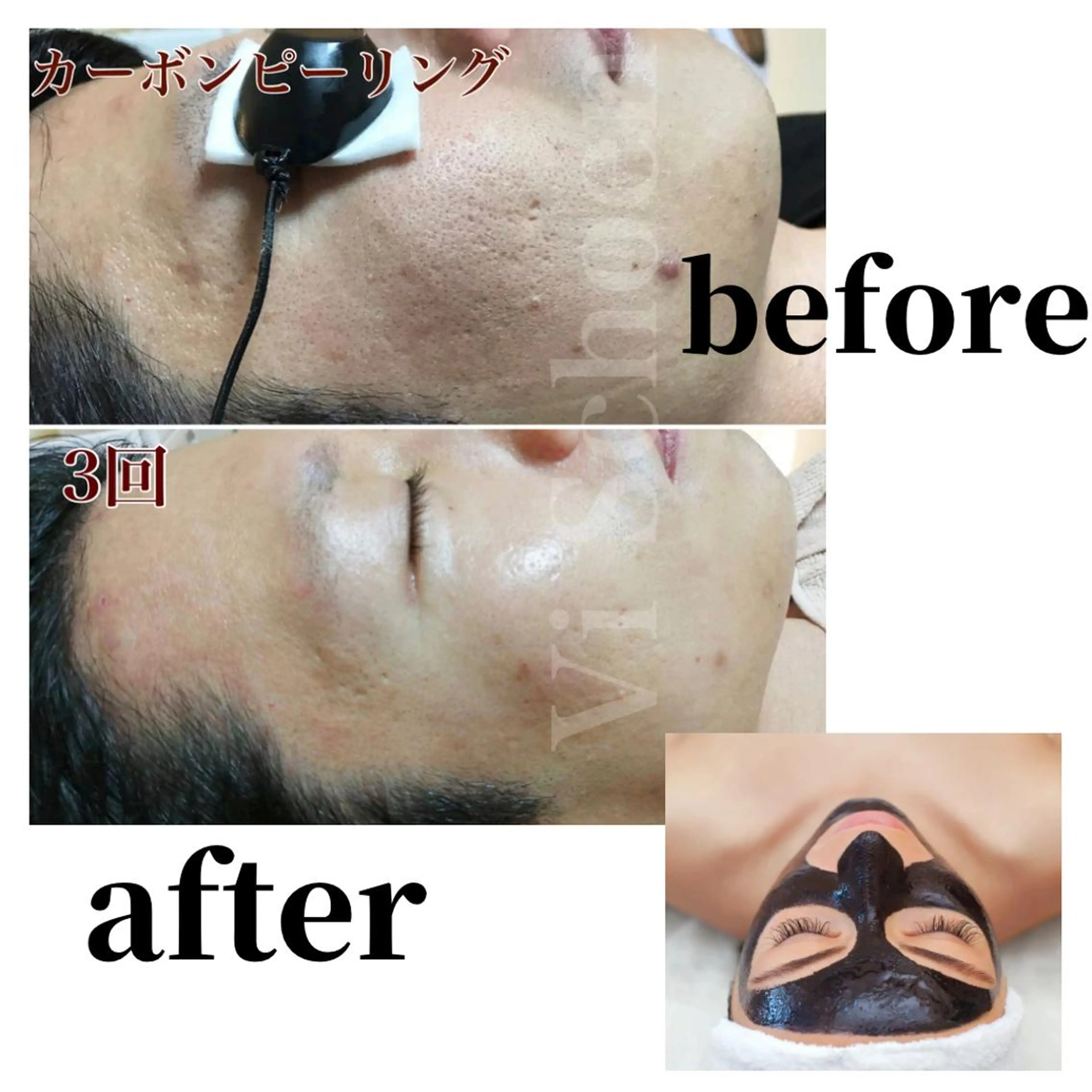●ミニモ限定【毛穴ケアフェイシャル】カーボンピーリング1パーツ◎2000の写真