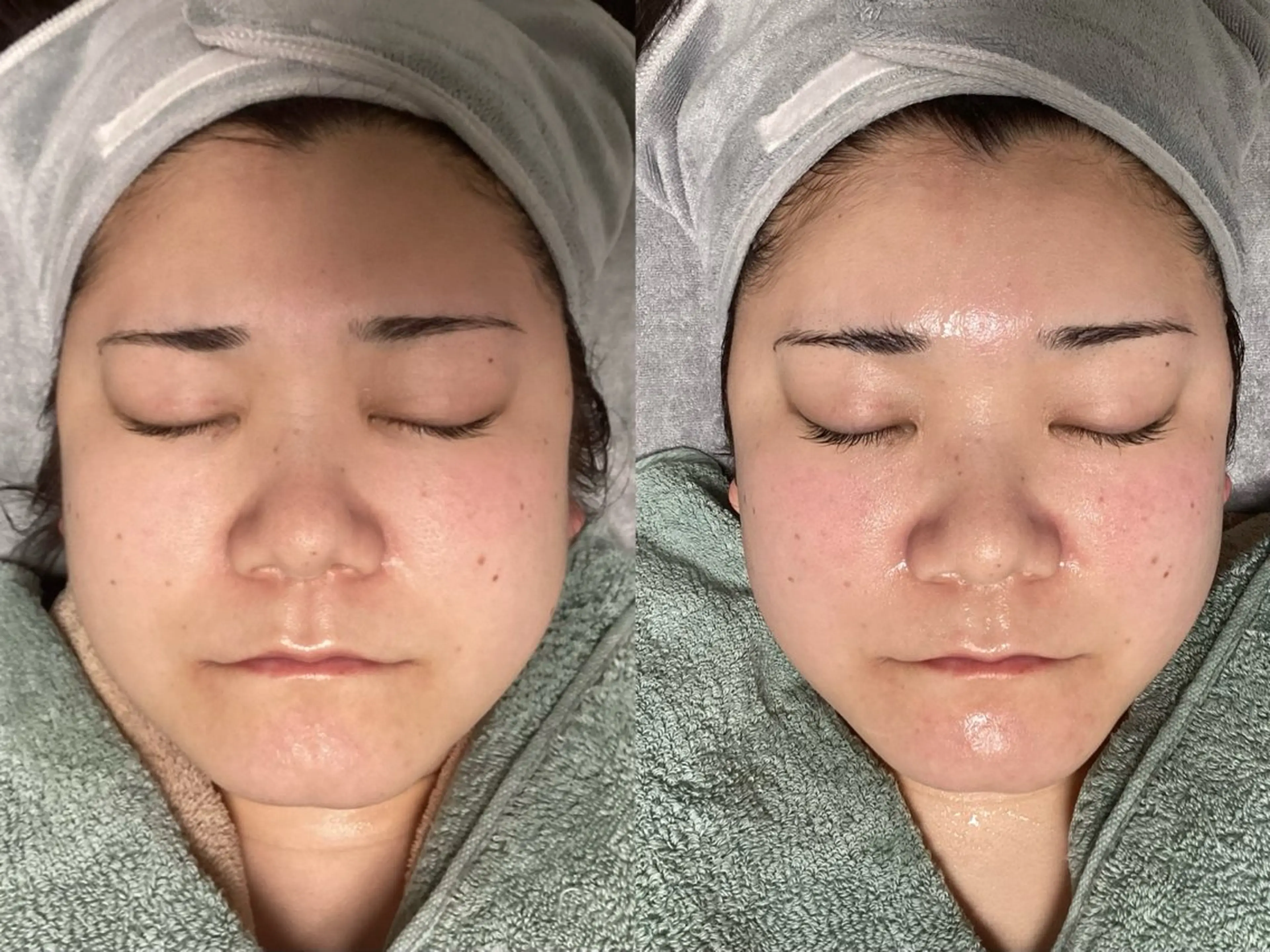 【秋限定毛穴レスと小顔同時に実現】毛穴ディープ洗浄×小顔リフトリンパマッサージ¥11900の写真