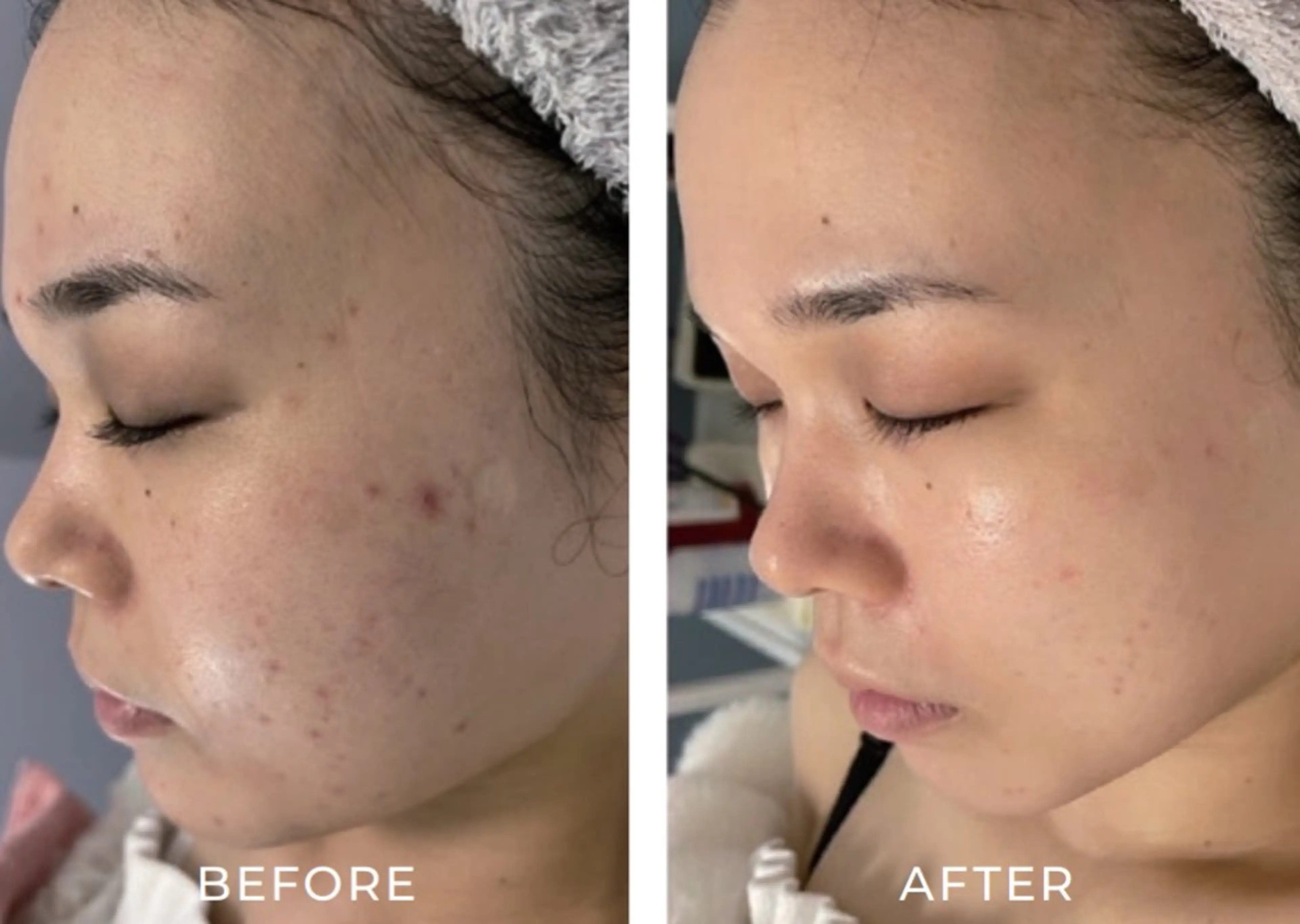 エステ リラク 毛穴ケア くすみ肌 ハーブピーリングのエステ・リラクイメージ