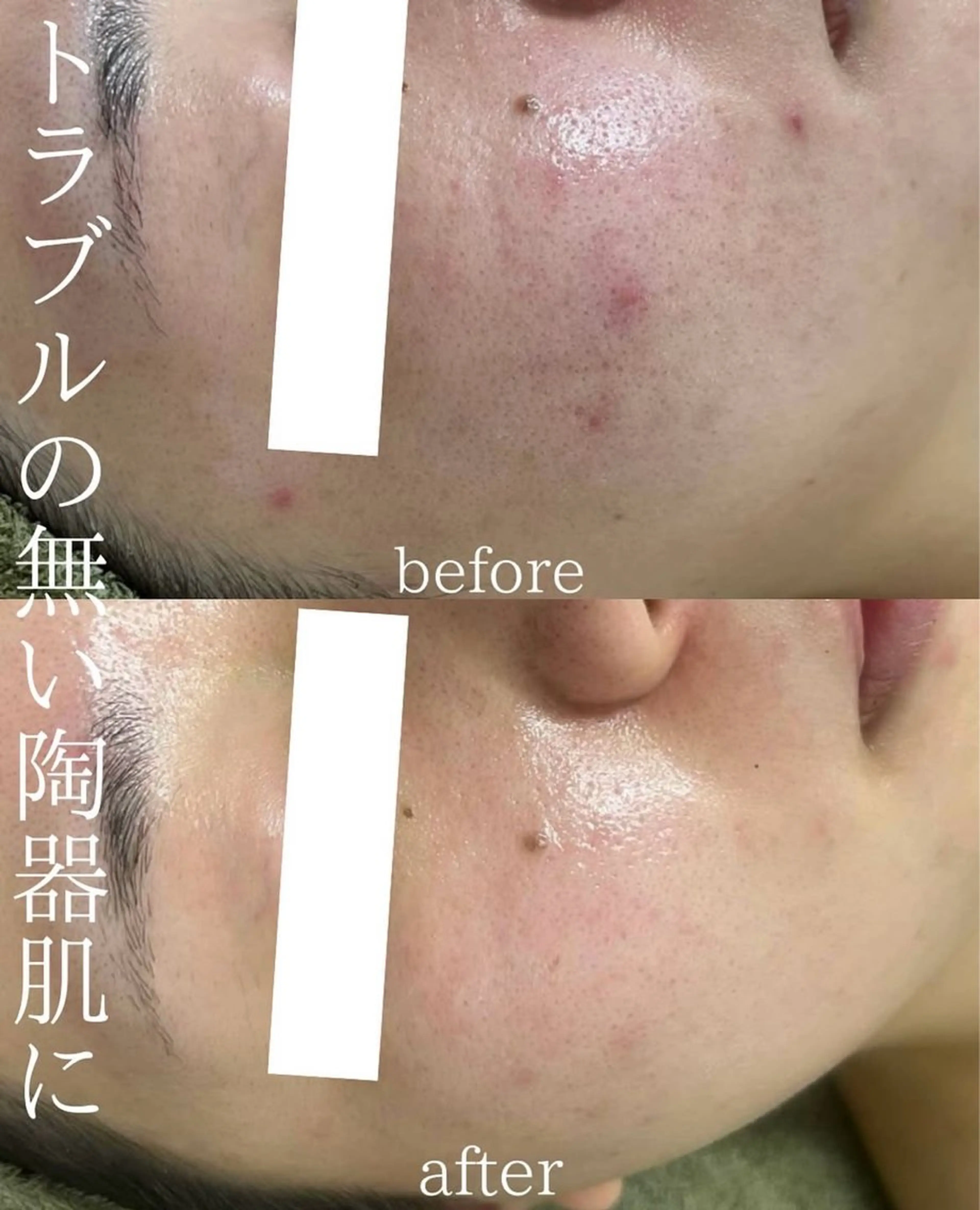 韓国美肌/肌質改善 【天神】yuiのエステ・リラクイメージ