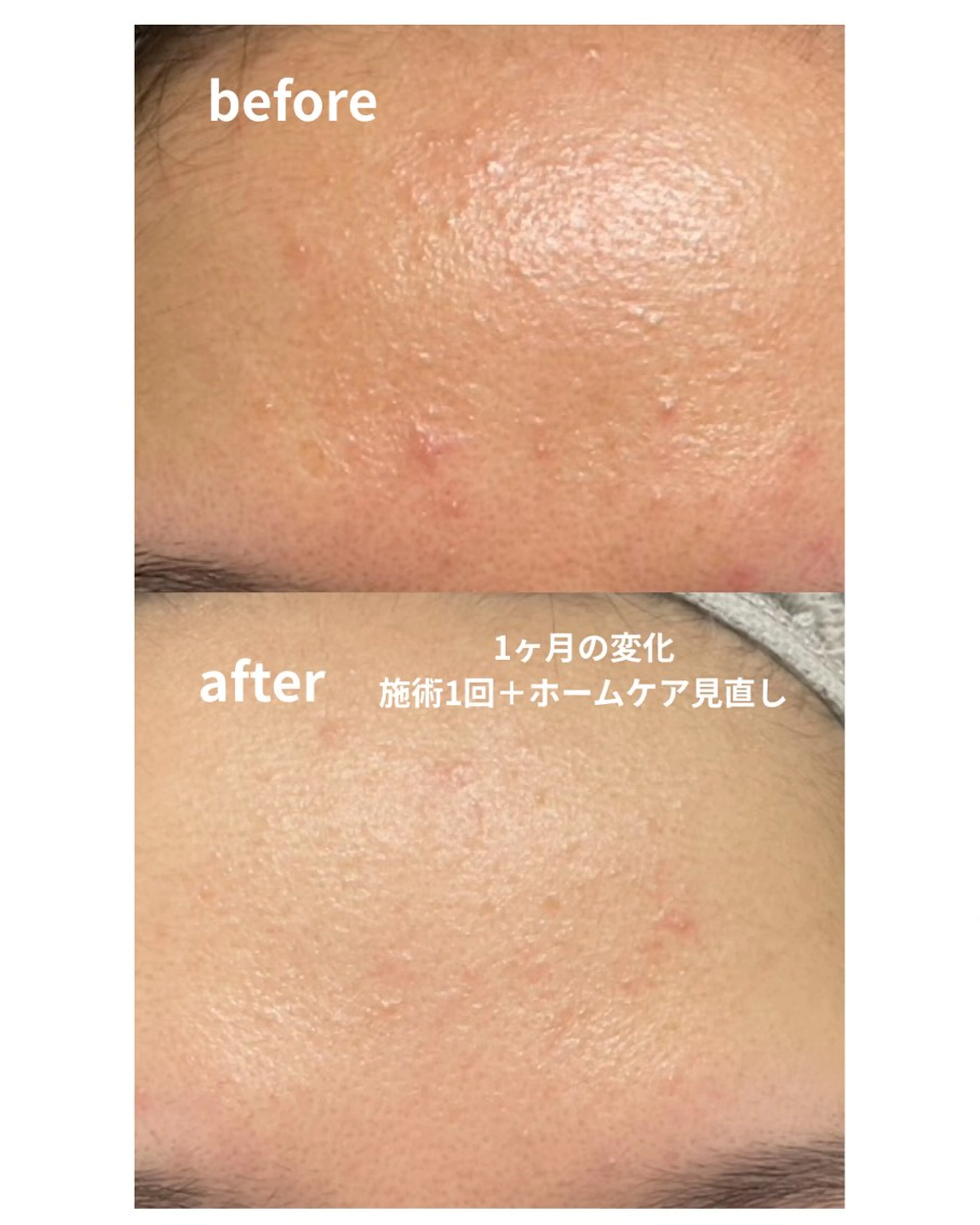 【ミニモ限定/フェイシャルモニター様募集】ニキビ・赤味・敏感肌の方向け/お悩み改善コースの写真