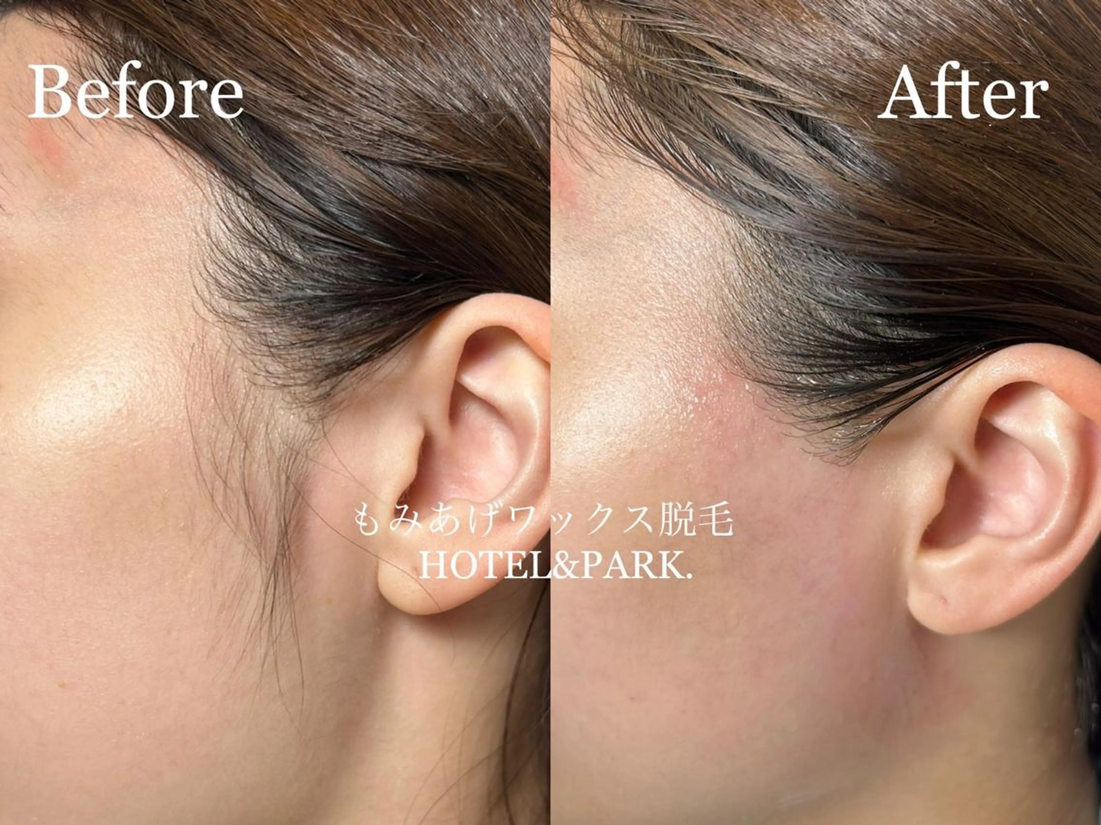 HOTEL&PARK . ワックス脱毛のエステ・リラクイメージ