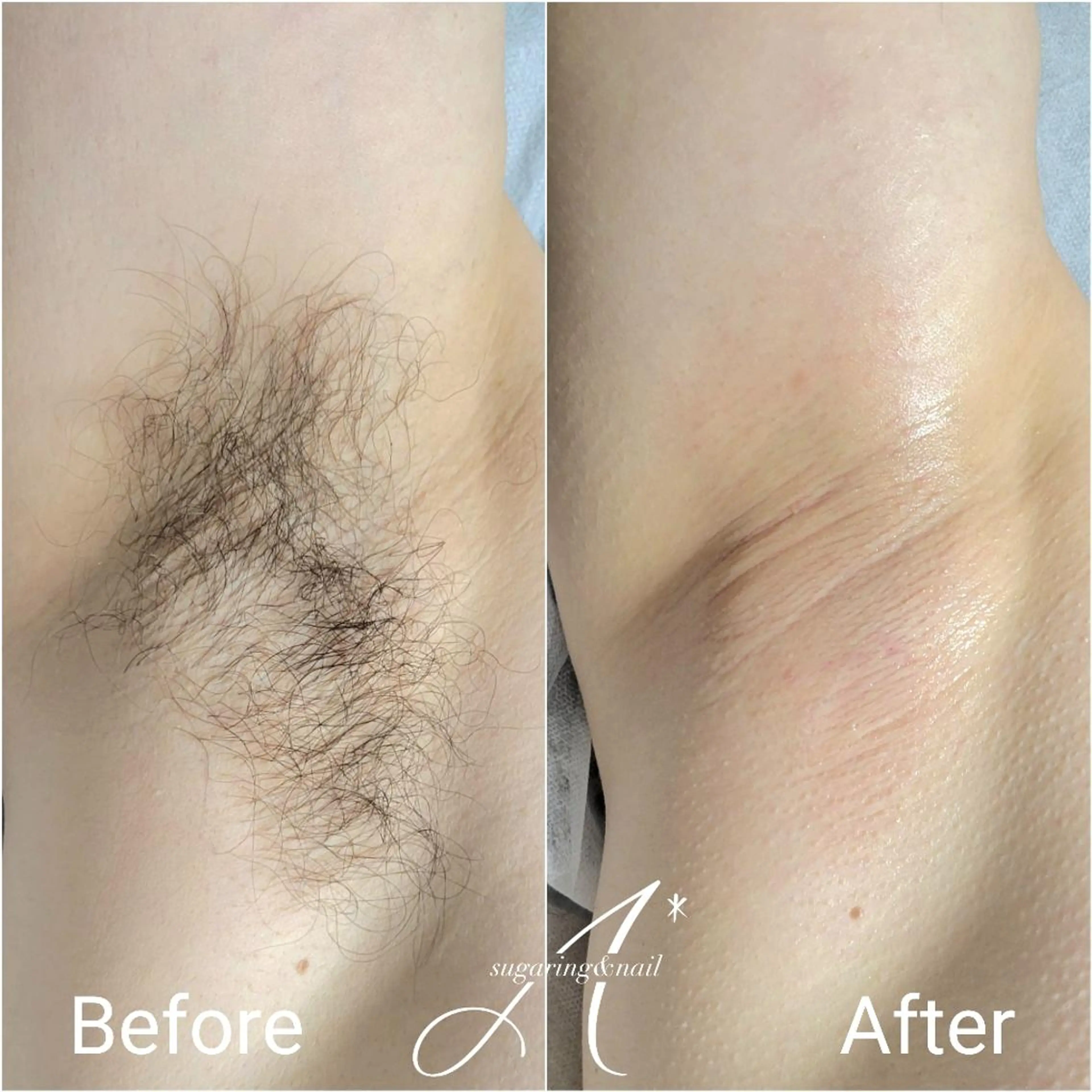 脇脱毛🍋シュガーリングの写真