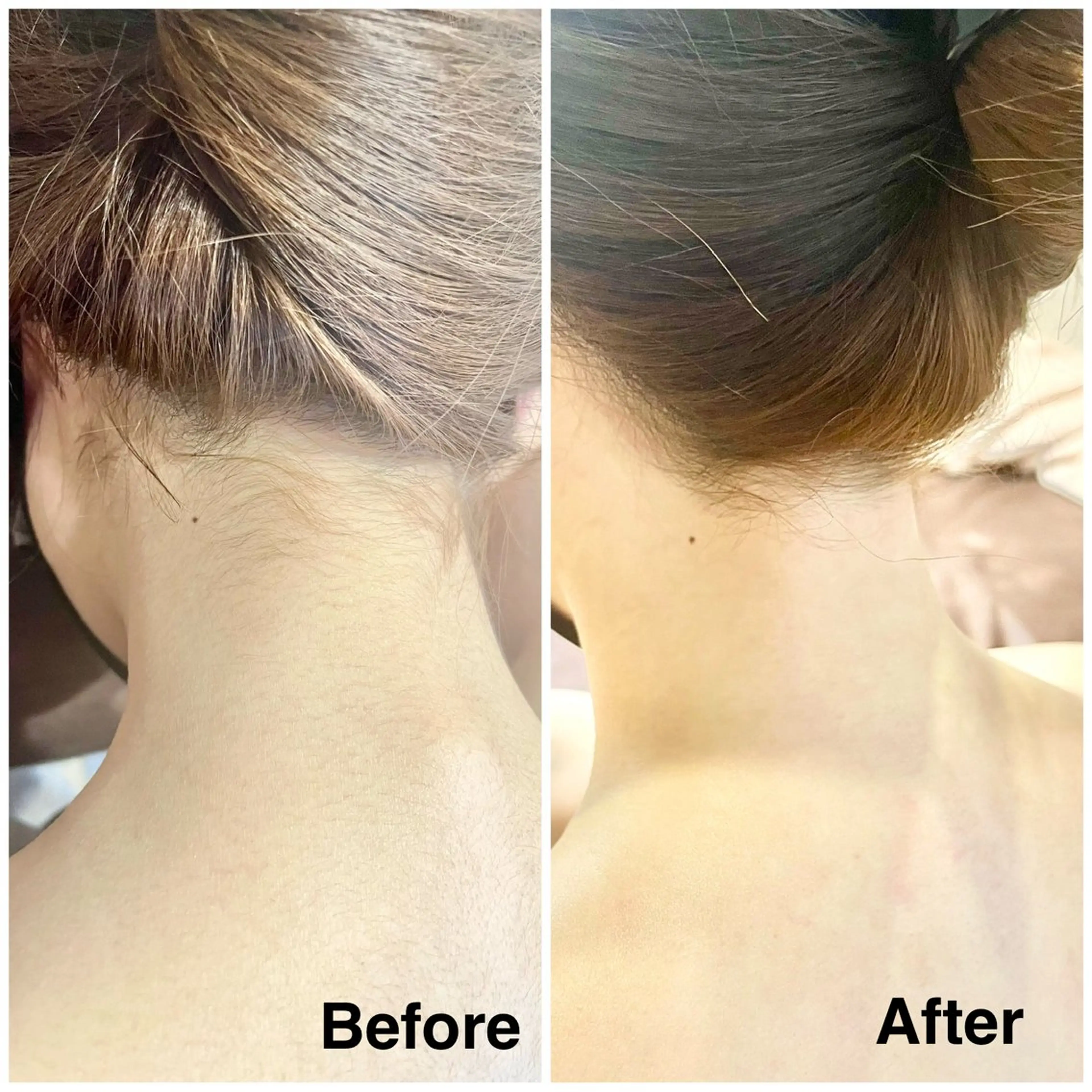 【後ろ姿美人】うなじ＋背中上部⭐︎シュガーリング脱毛の写真