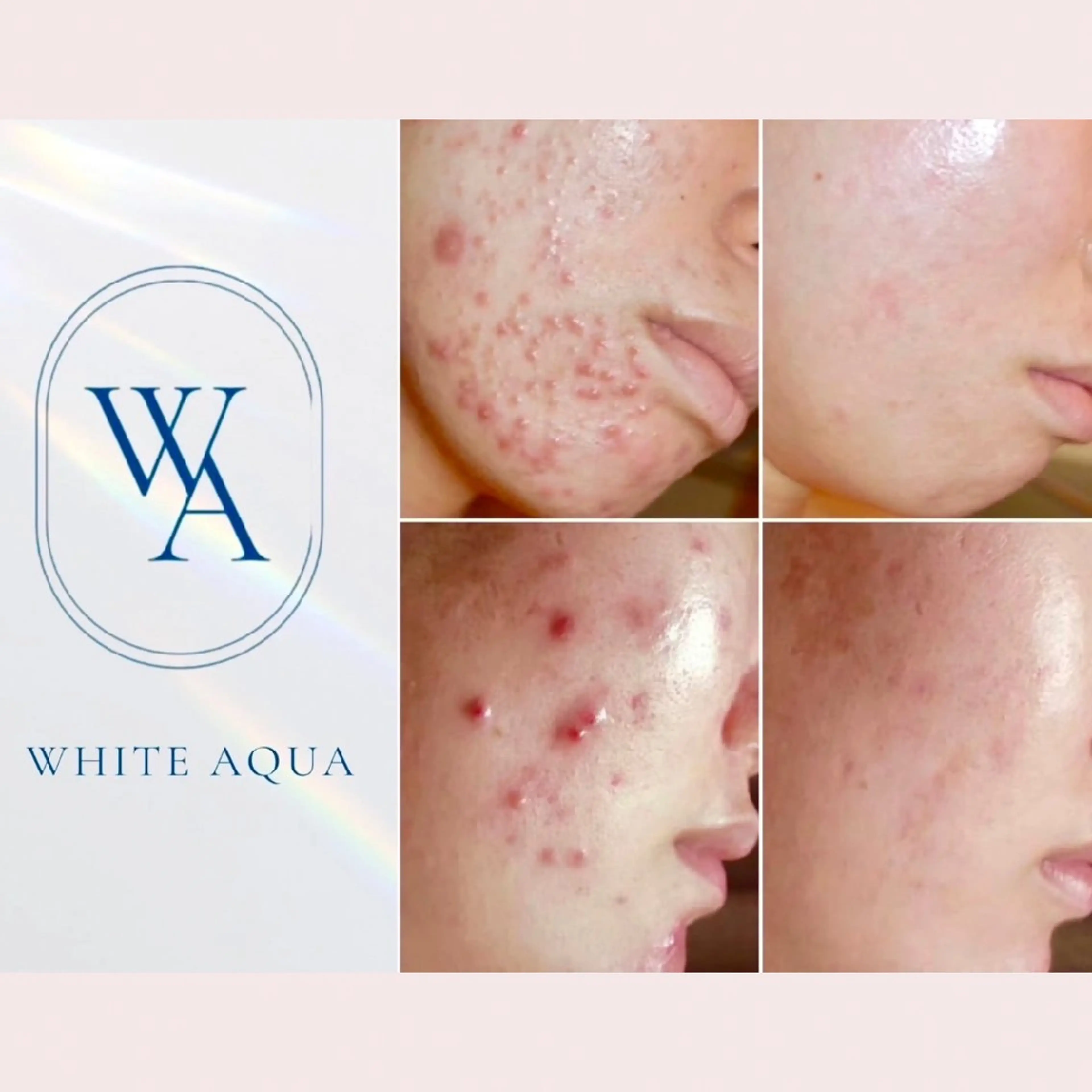 【ハーブピーリングor韓国式肌育ピール】【メニューに迷ったらこちら】お悩みに合わせて施術させて頂きます✨の写真