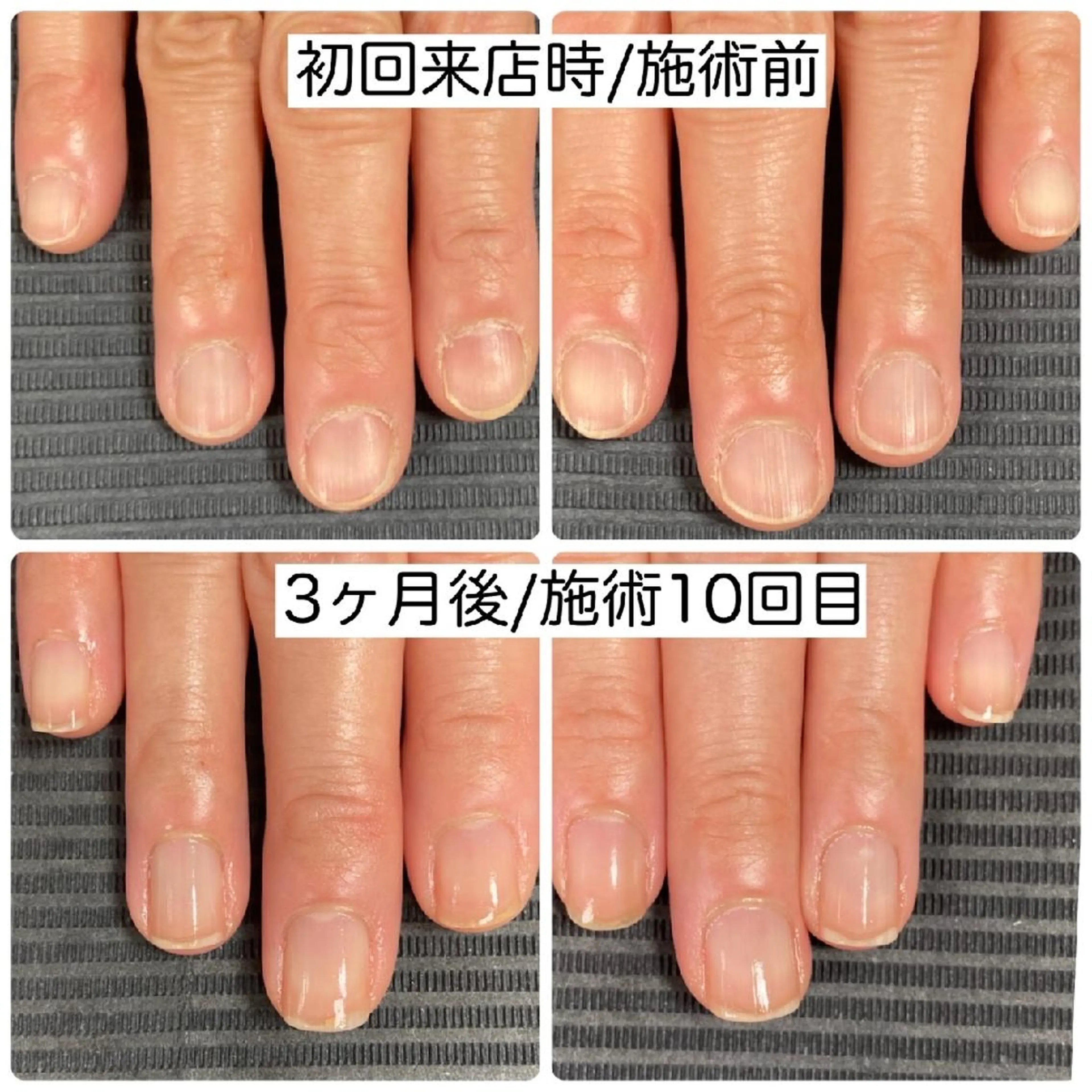 最強のネイルケア　モニター様募集の写真