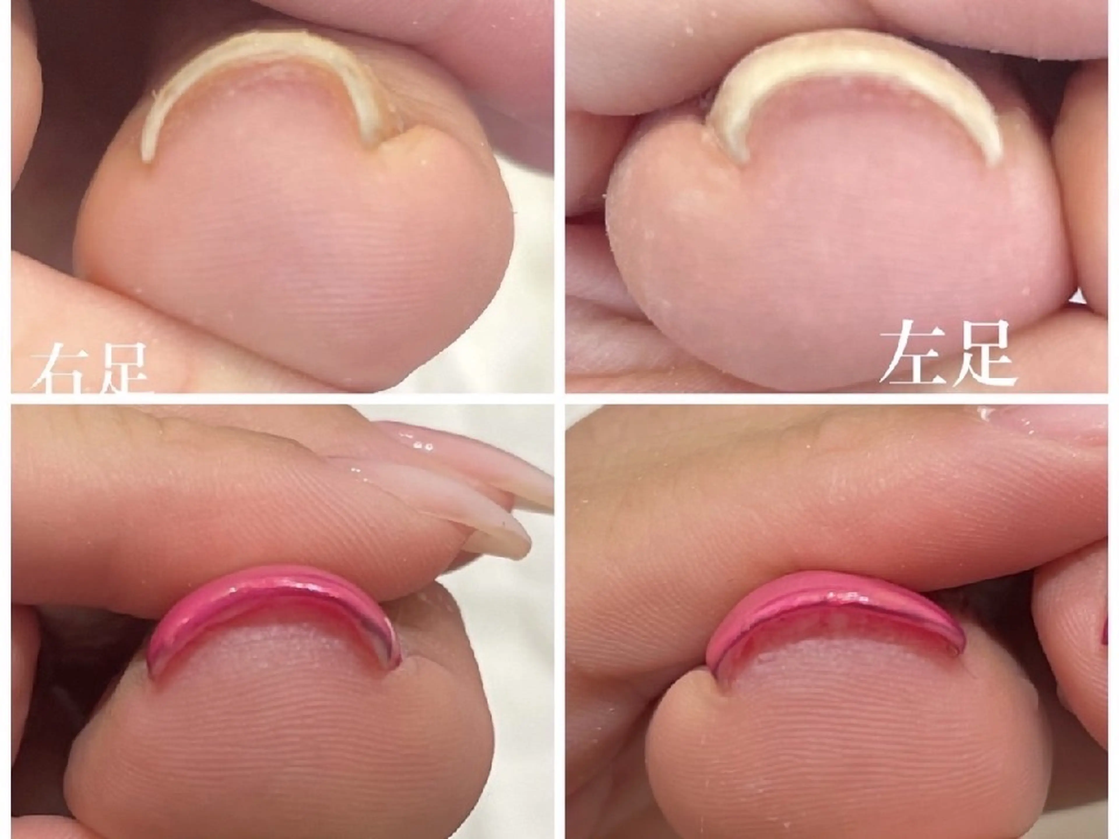親指巻き爪1本の写真