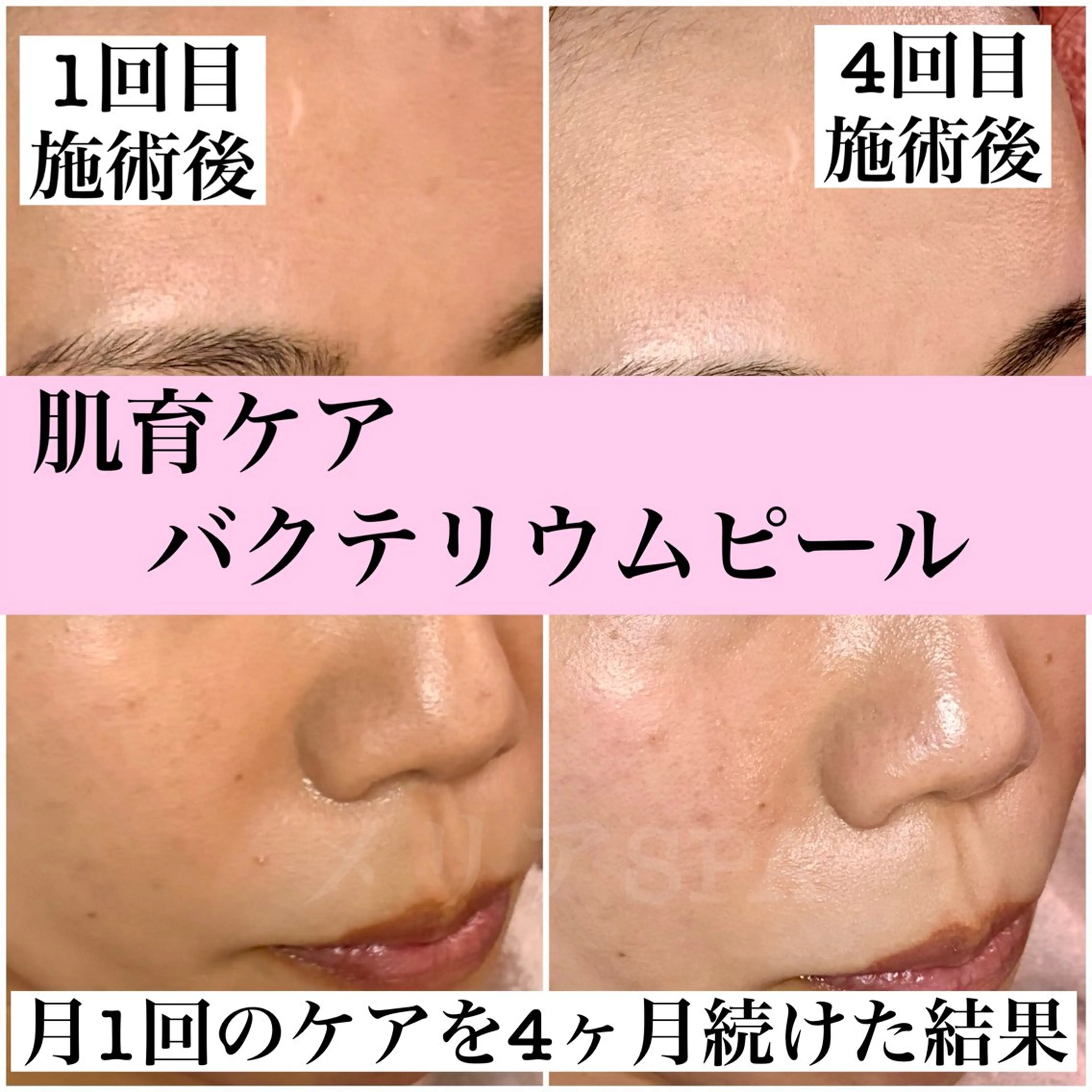 肌育フェイシャル★バクテリウムピール 60分の写真