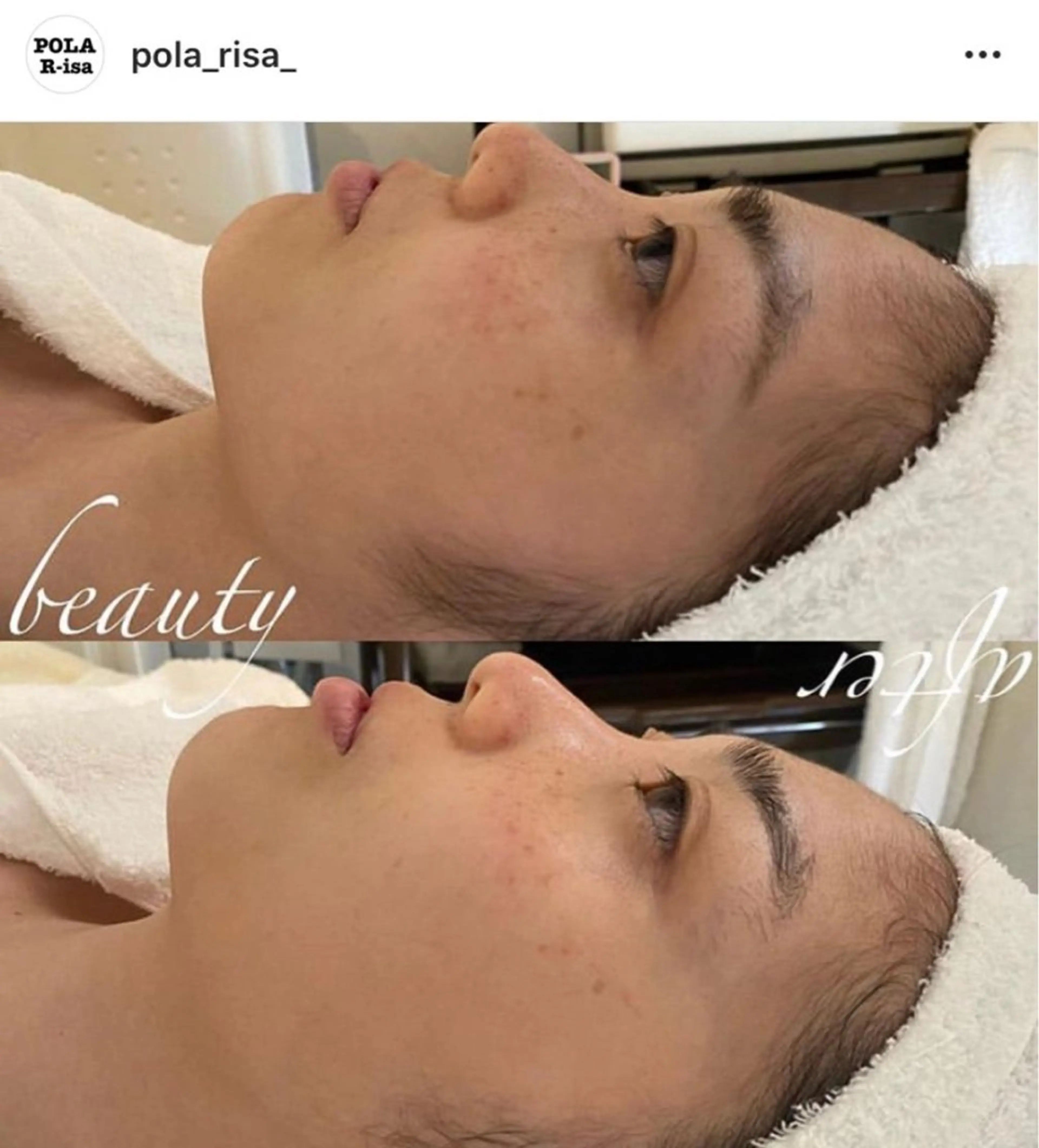 【当店が初めての方限定】保湿フェイスマッサージ＋毛穴クレンジング🪠🤍まずは小顔ケアを体感したい方✨の写真