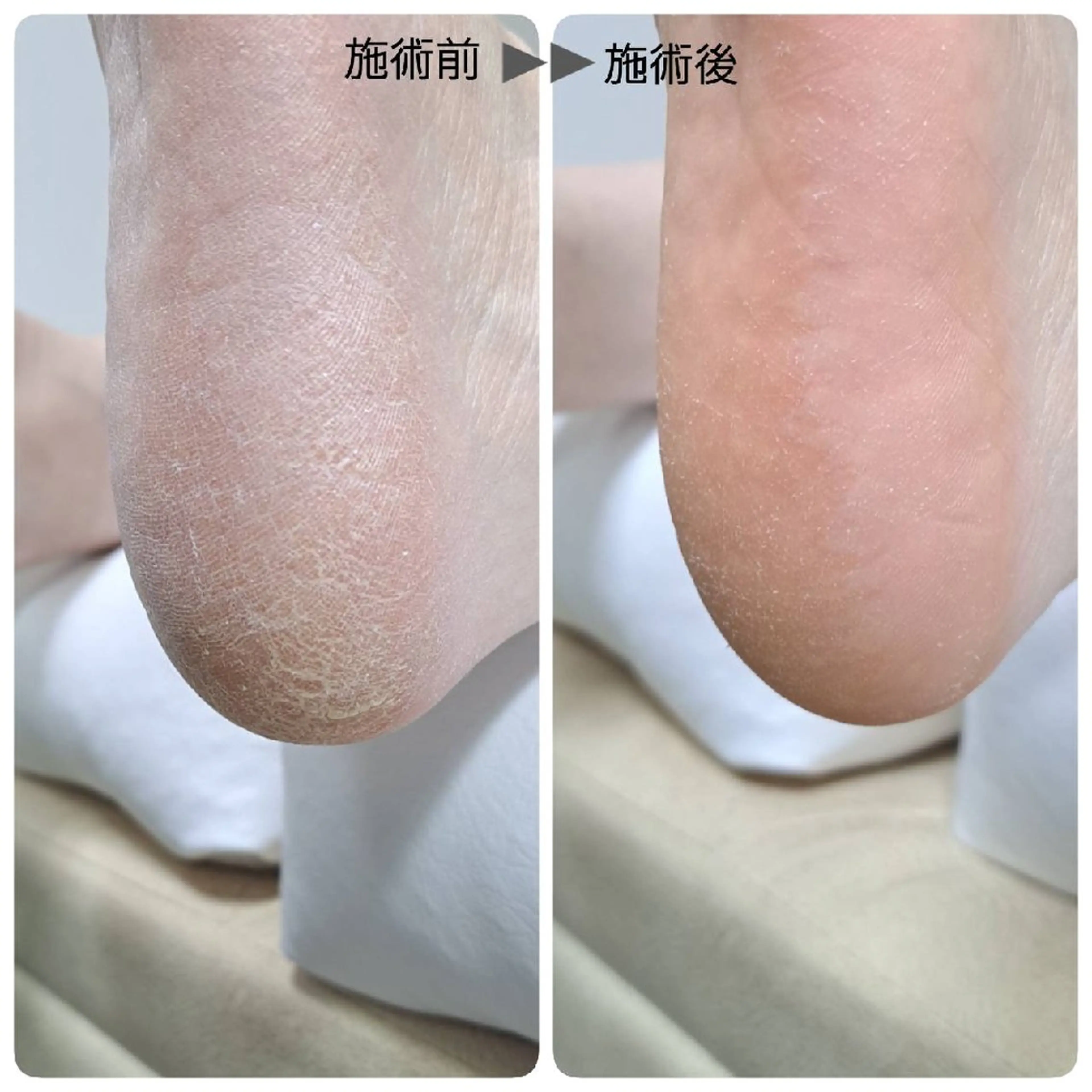 足裏角質ケアお試し価格の写真