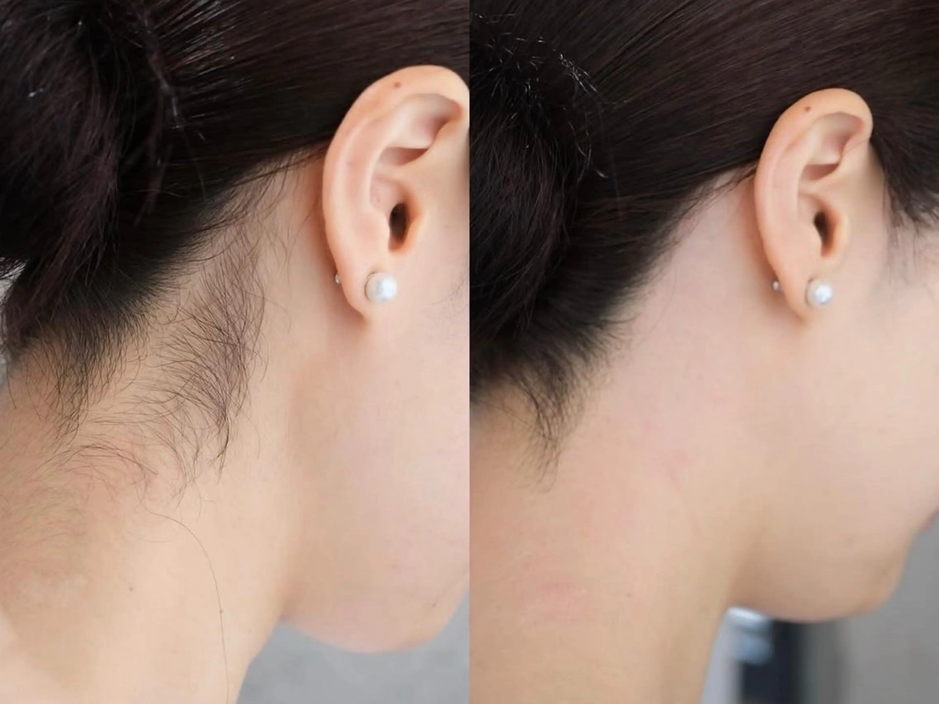 【うなじワックス脱毛】気になる首元をスッキリ!ブライダル/イベント前にもの写真