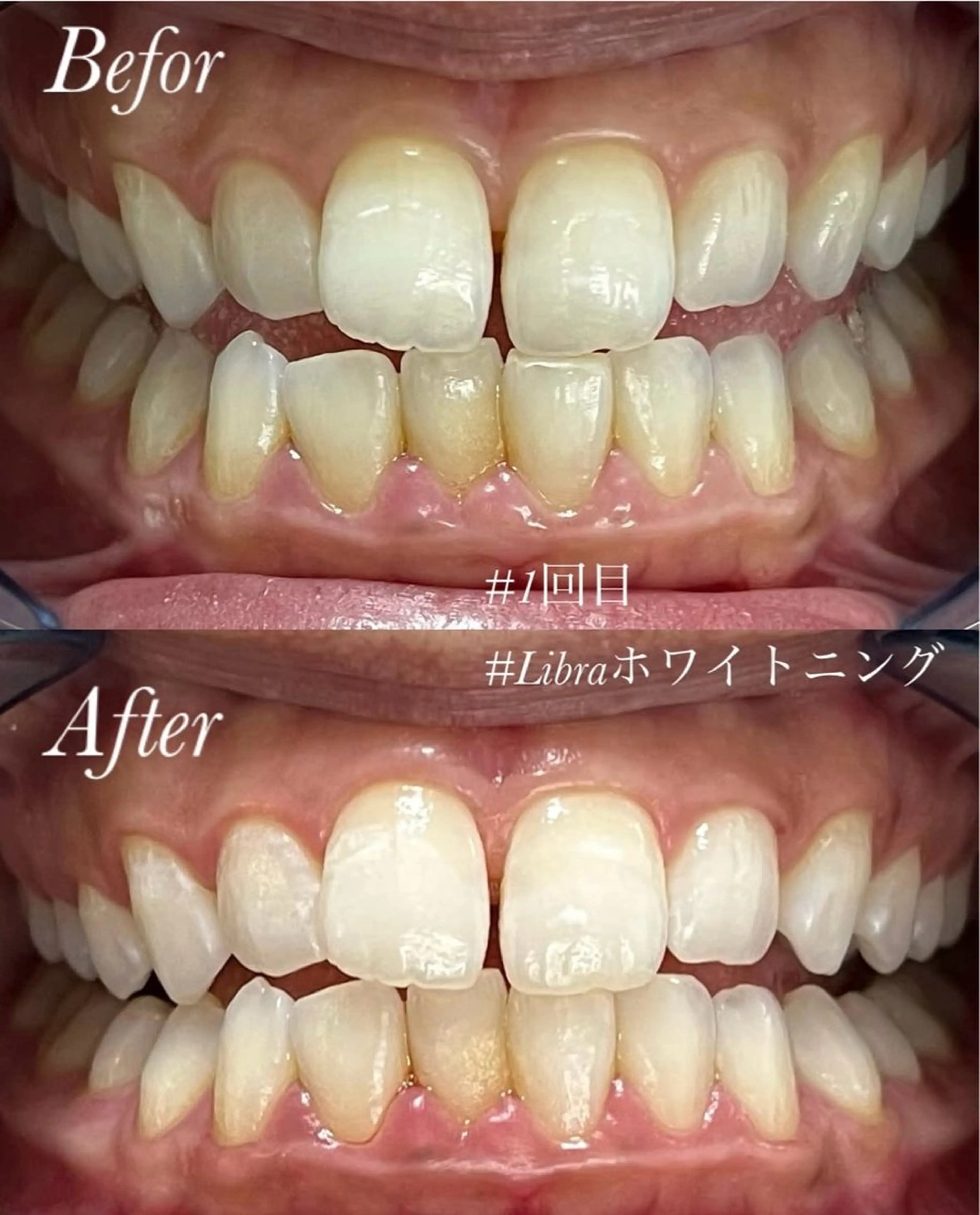 🫧セルフホワイトニング🫧初回体験10分×3回 〜安心のカウンセリング付き〜💛の写真