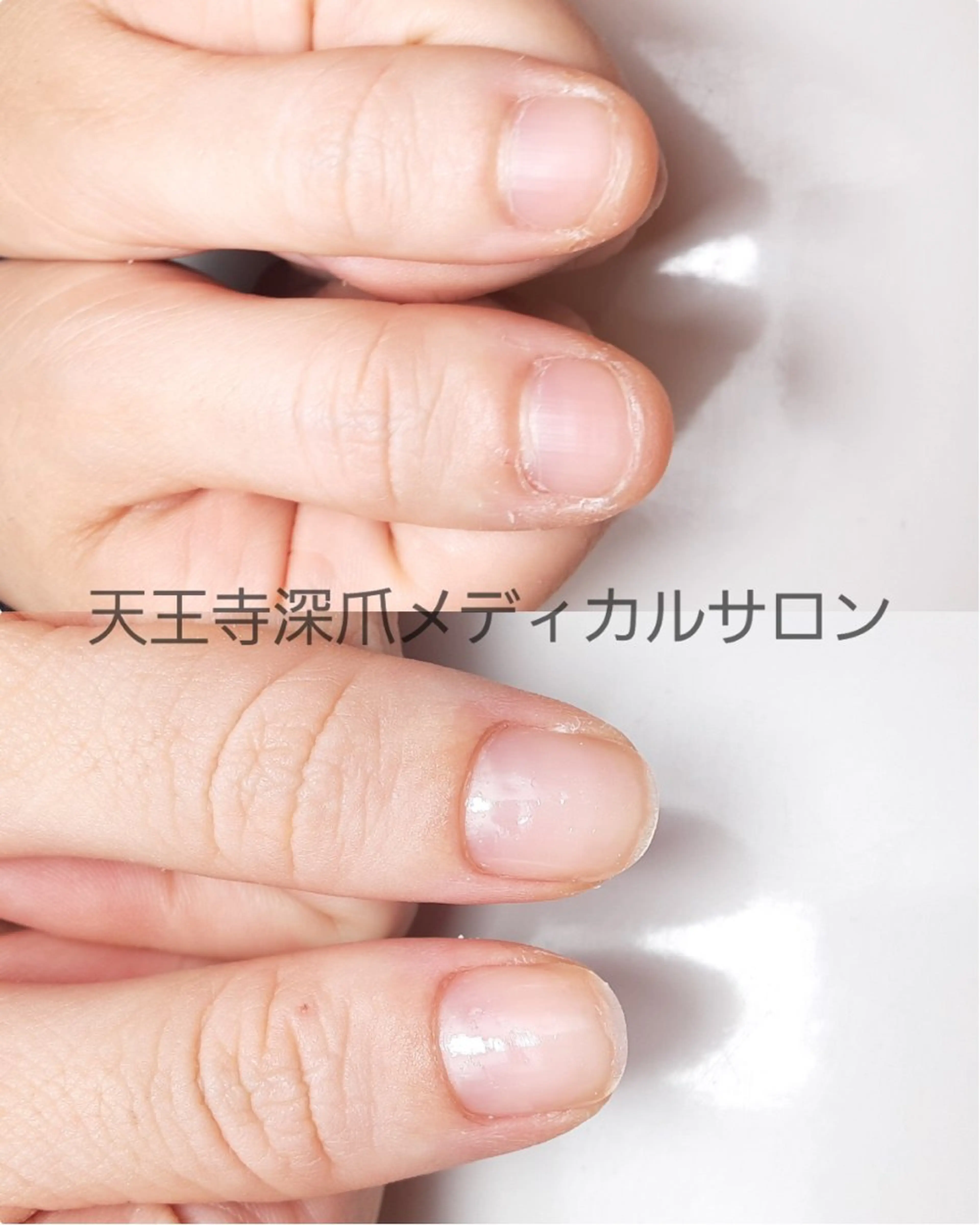 ネイル 天王寺 深爪メディカルサロンのネイルデザイン