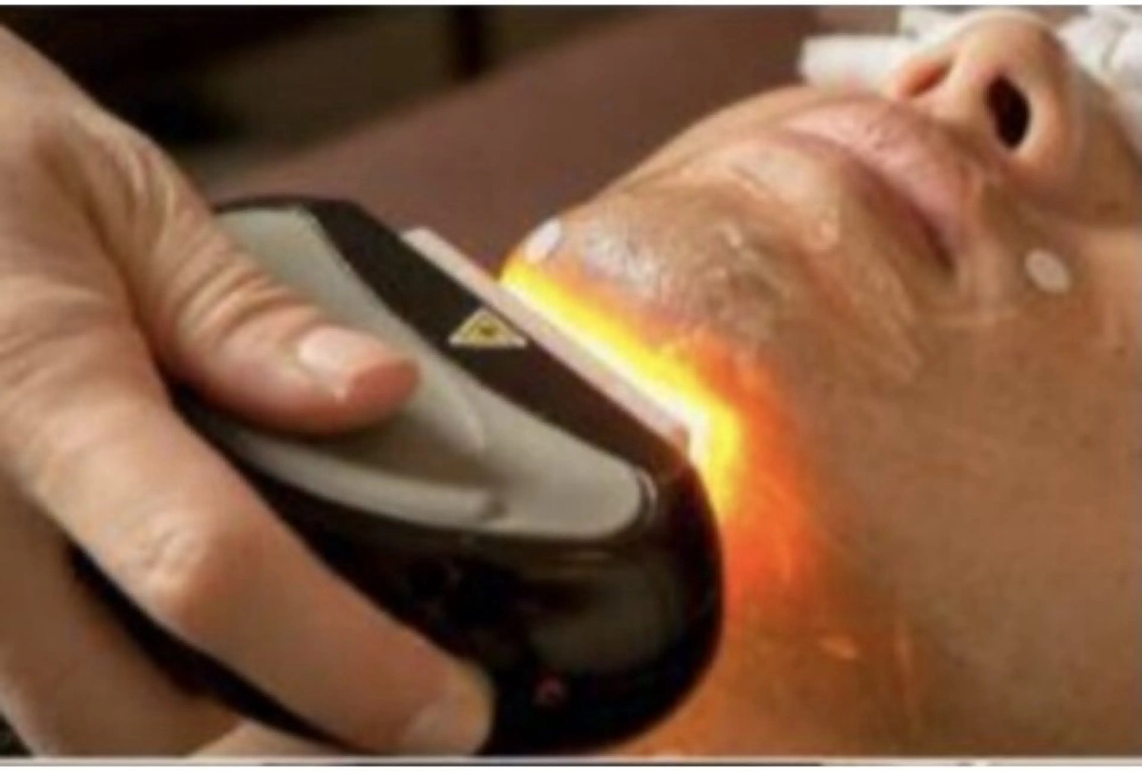 初回メンズ全身脱毛(VIO抜き)の写真